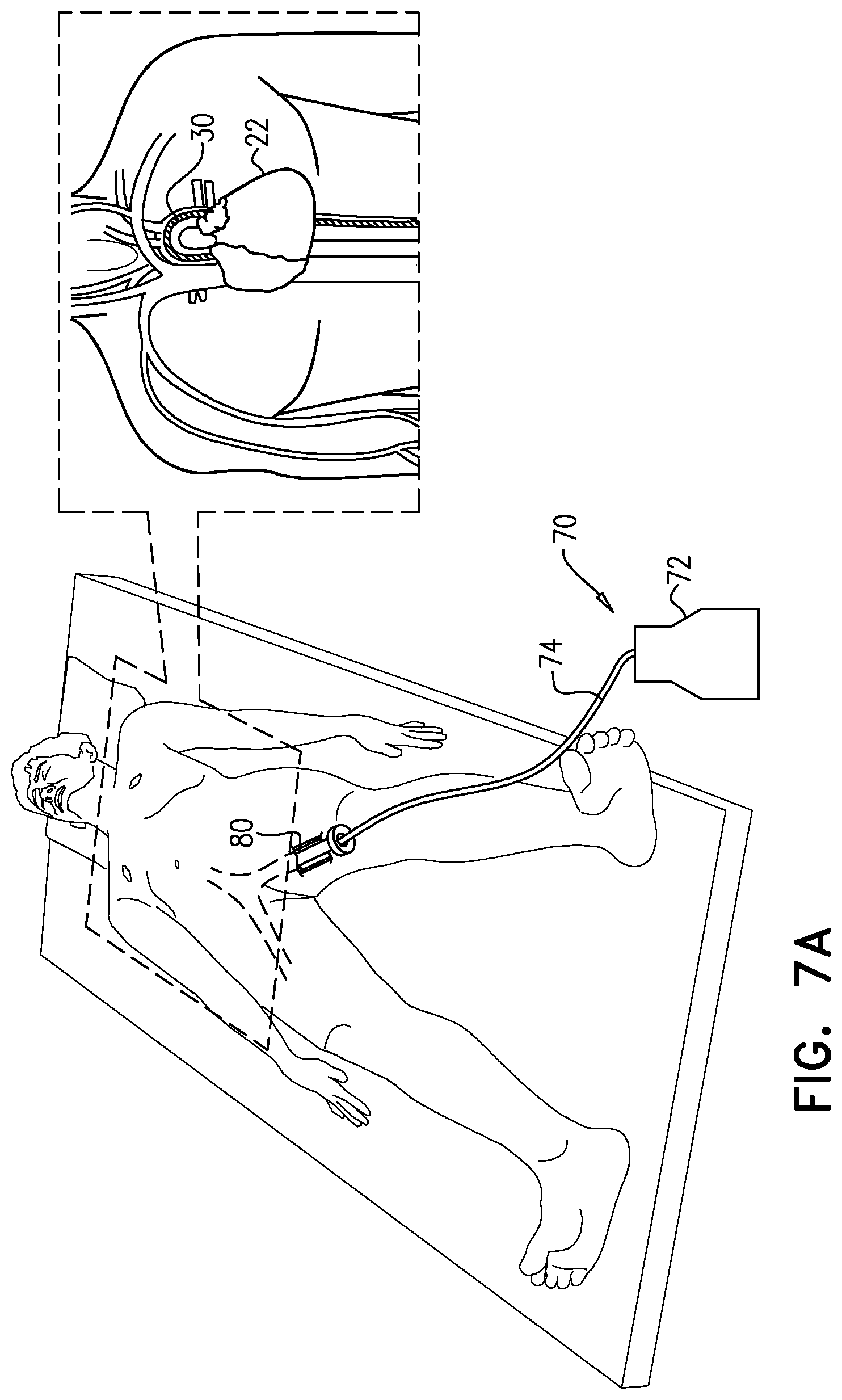 Patent US12090314 Figure 9 – Ventricular assist device