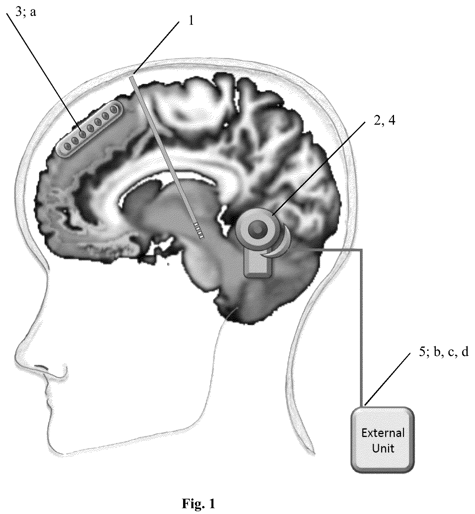 Patent US12090317 Figure 1 – Adaptive deep brain stimulation of the superolateral medial forebrain bundle