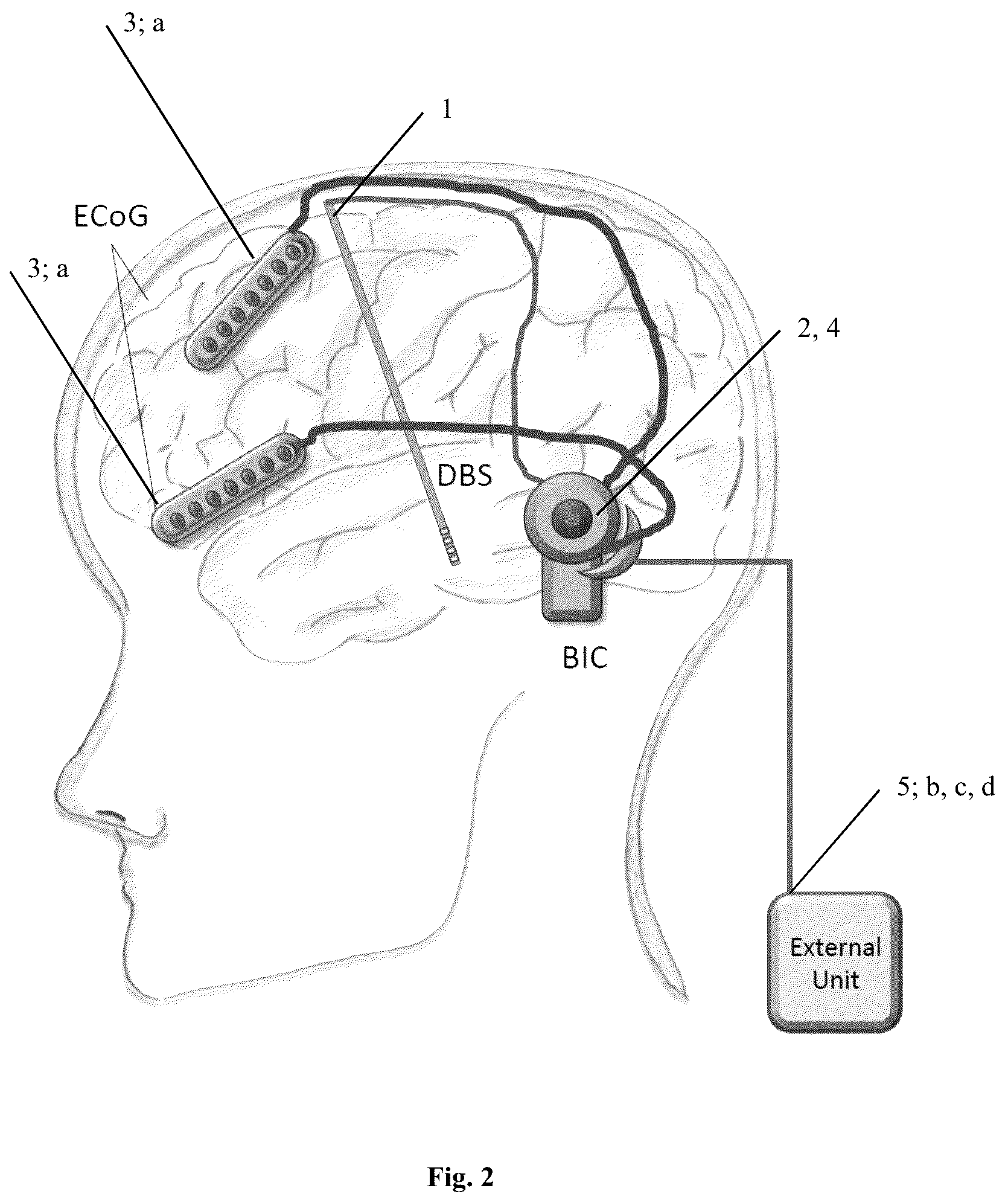 Patent US12090317 Figure 2 – Adaptive deep brain stimulation of the superolateral medial forebrain bundle