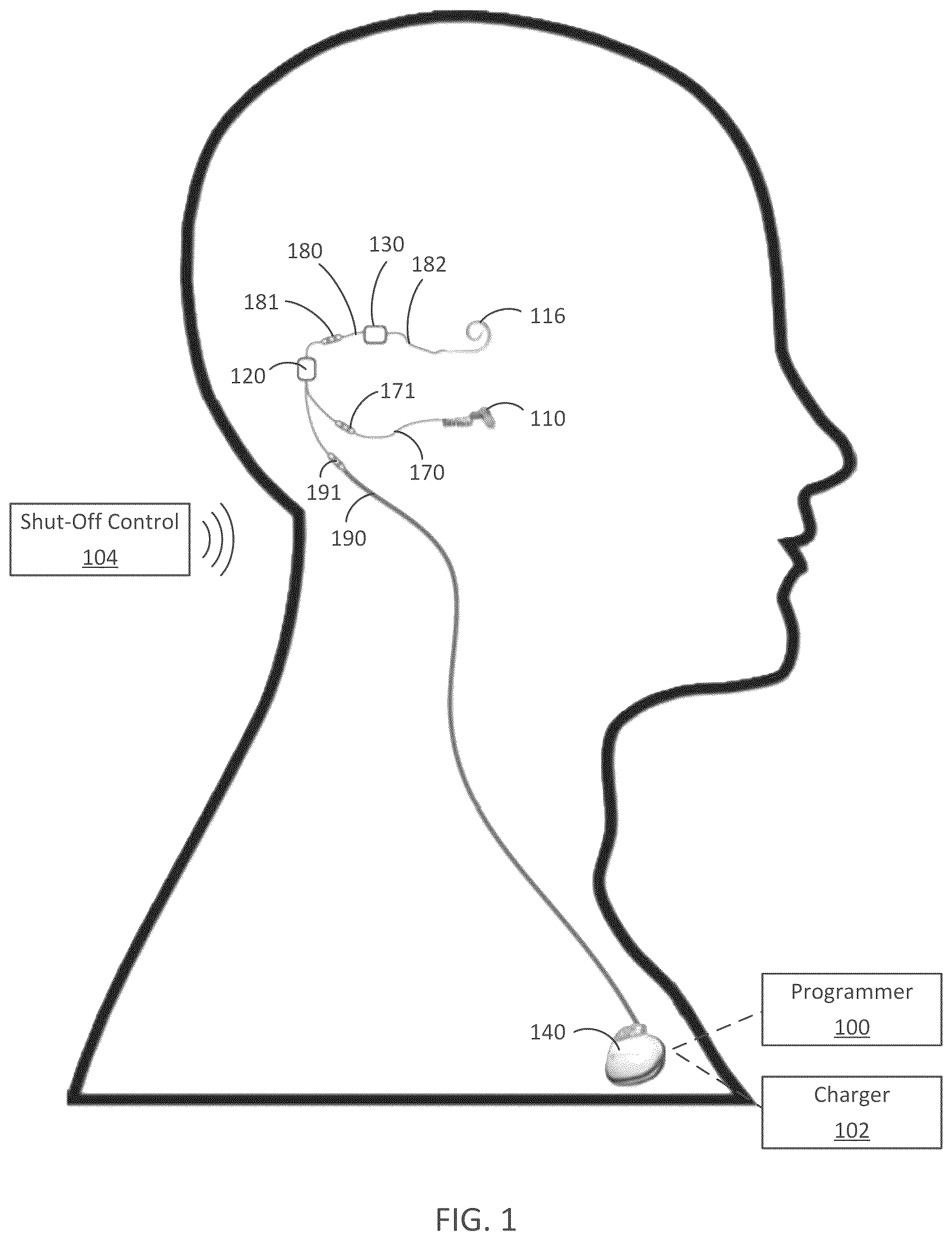 Patent US12090318 Figure 1 – Implantable cochlear system with integrated components and lead characterization