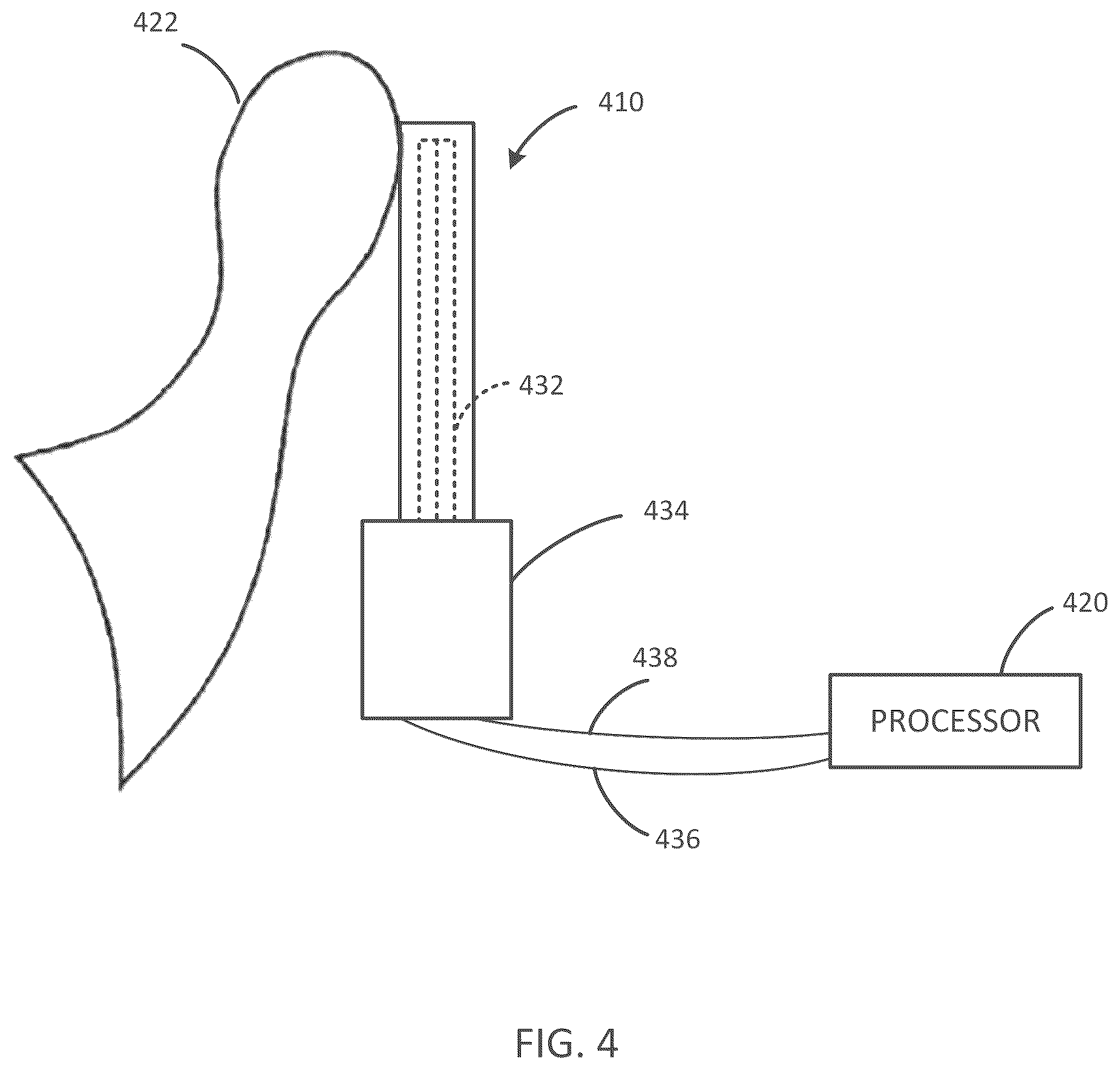 Patent US12090318 Figure 4 – Implantable cochlear system with integrated components and lead characterization