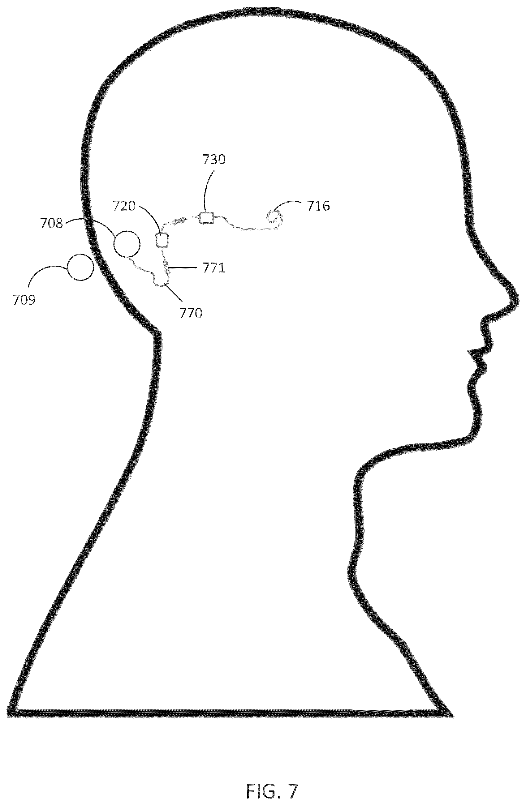 Patent US12090318 Figure 7 – Implantable cochlear system with integrated components and lead characterization