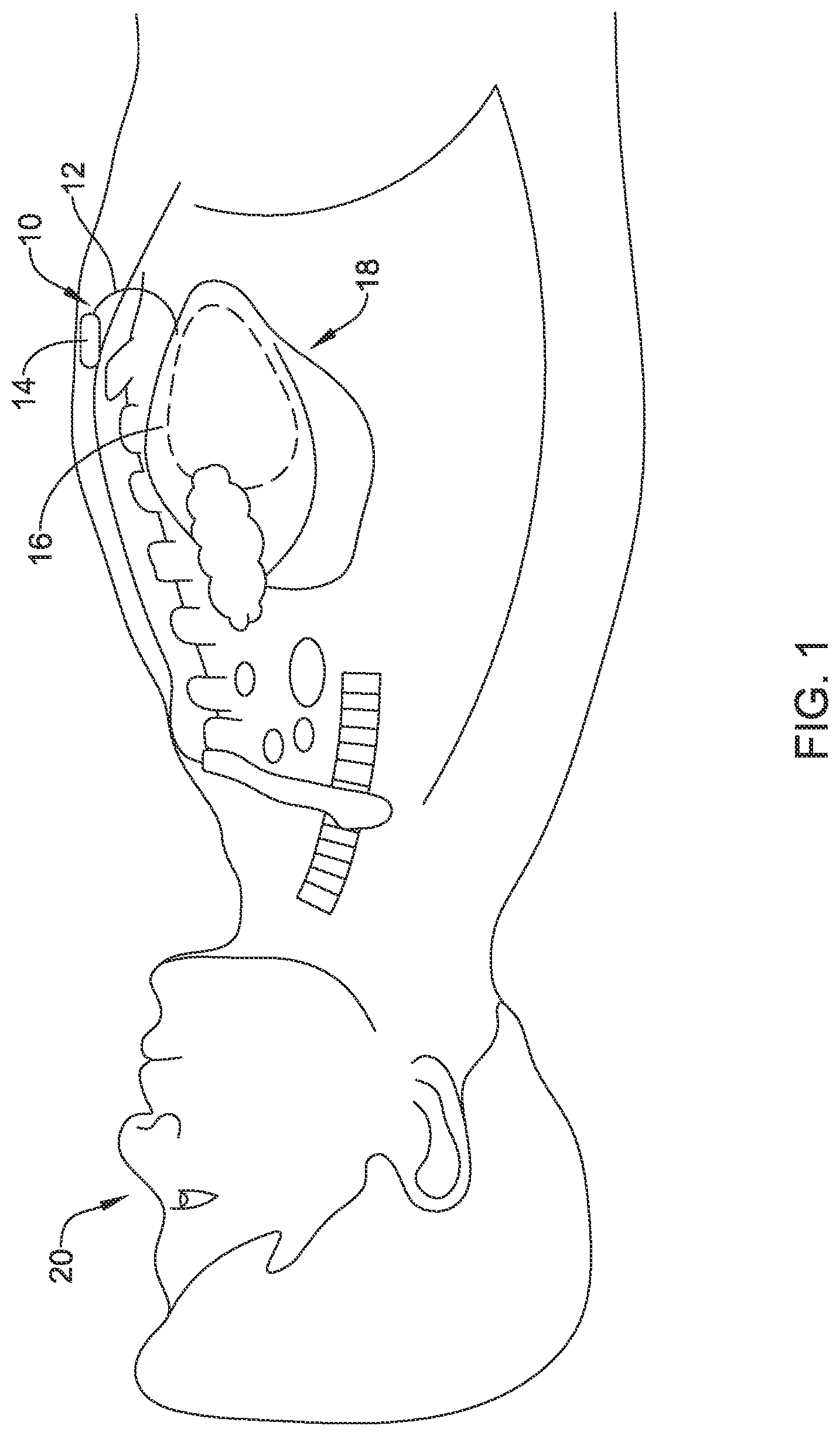 Patent US12090319 Figure 1 – Implantable medical devices and methods for making and delivering implantable medical devices