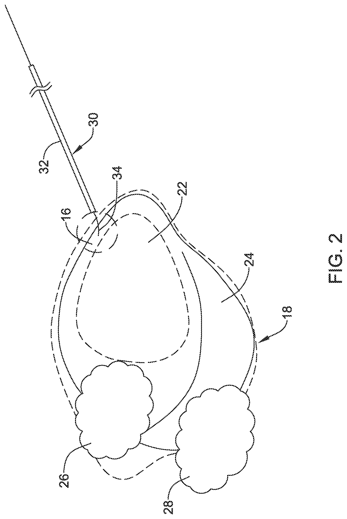 Patent US12090319 Figure 2 – Implantable medical devices and methods for making and delivering implantable medical devices