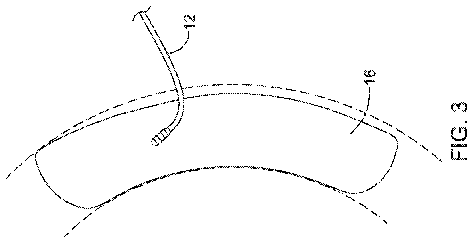 Patent US12090319 Figure 3 – Implantable medical devices and methods for making and delivering implantable medical devices