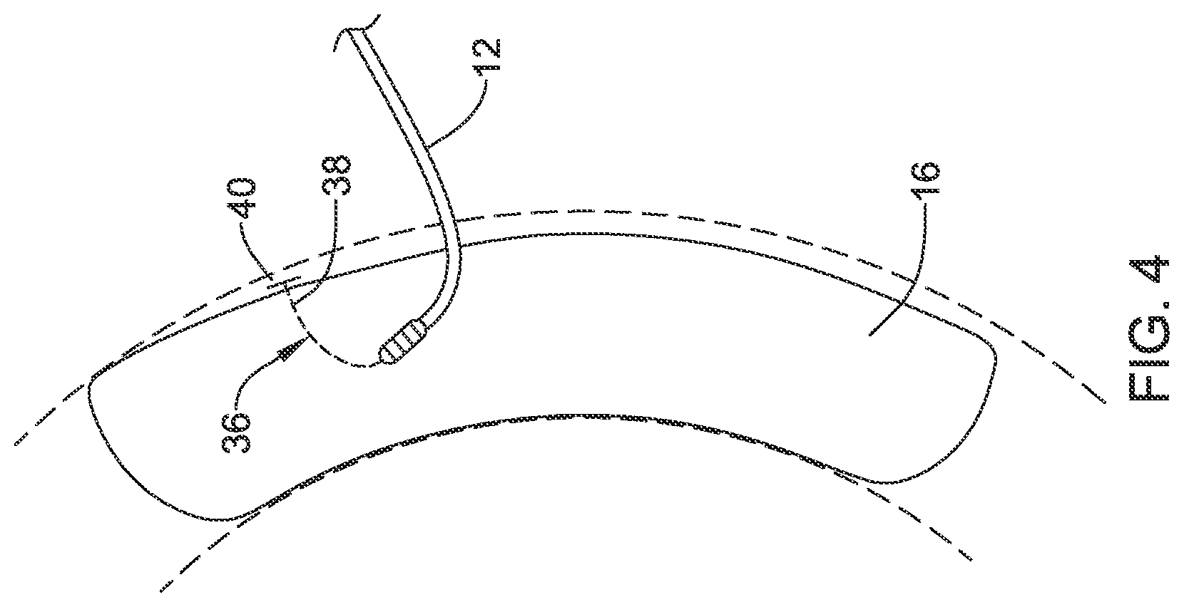 Patent US12090319 Figure 4 – Implantable medical devices and methods for making and delivering implantable medical devices