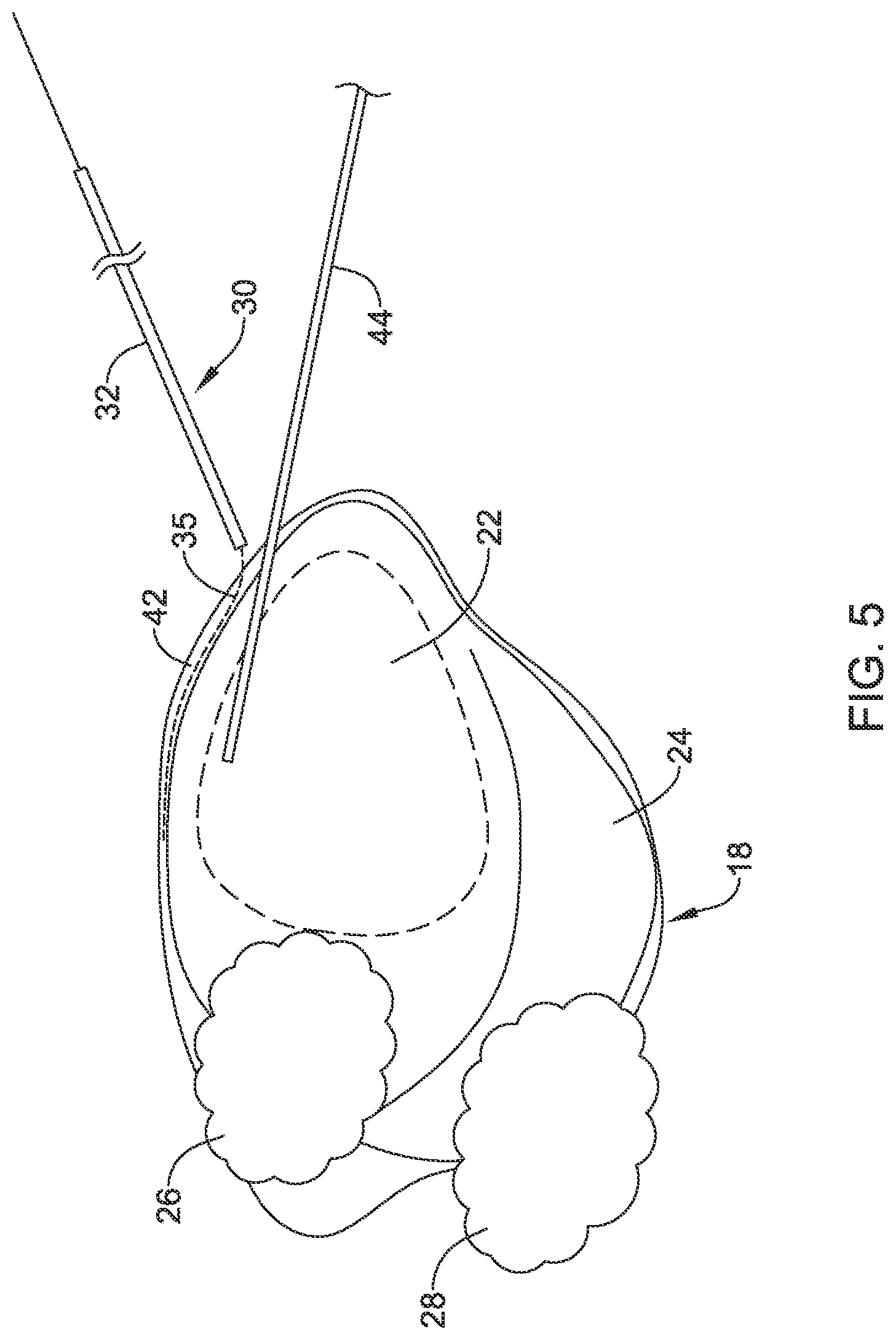 Patent US12090319 Figure 5 – Implantable medical devices and methods for making and delivering implantable medical devices