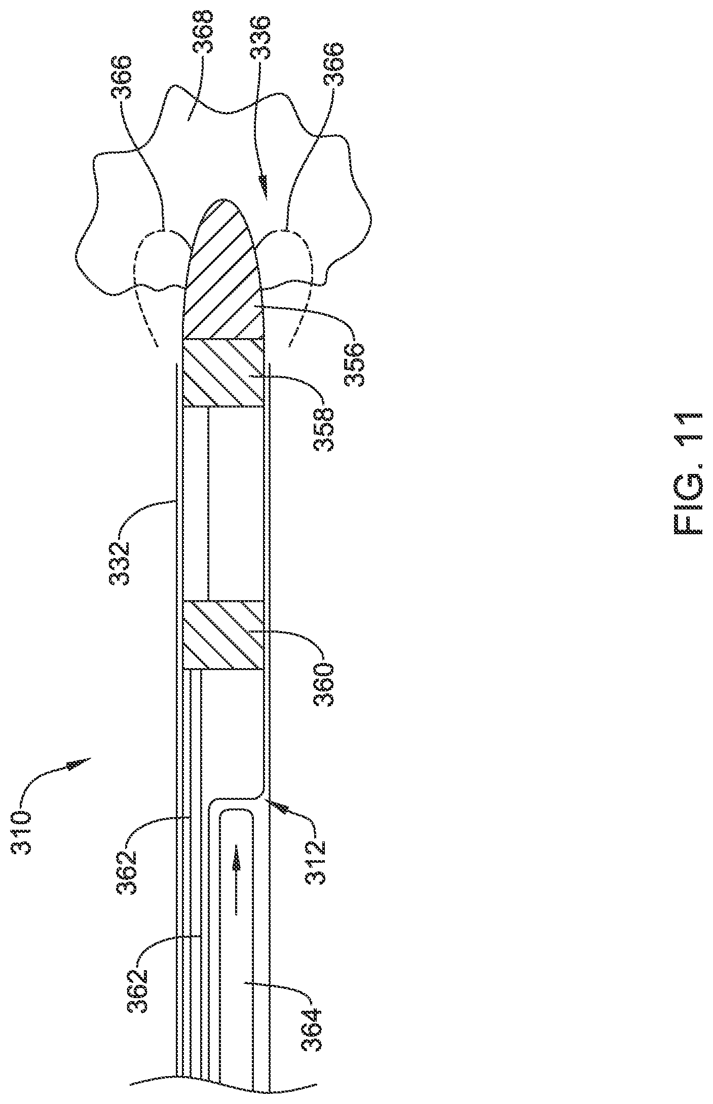 Patent US12090319 Figure 11 – Implantable medical devices and methods for making and delivering implantable medical devices