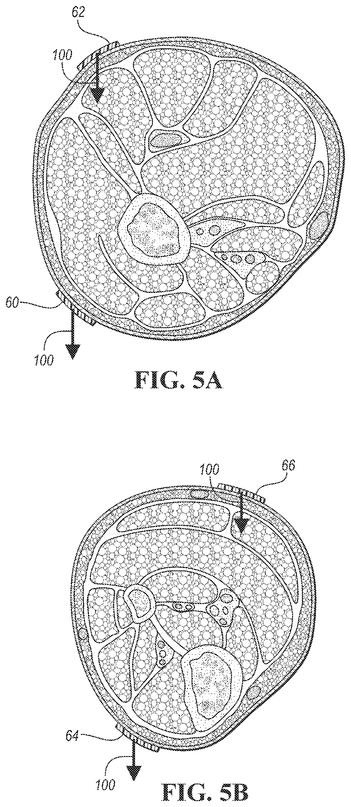 Patent US12090320 Figure 5 – Neuromuscular sensing device with multi-sensor array
