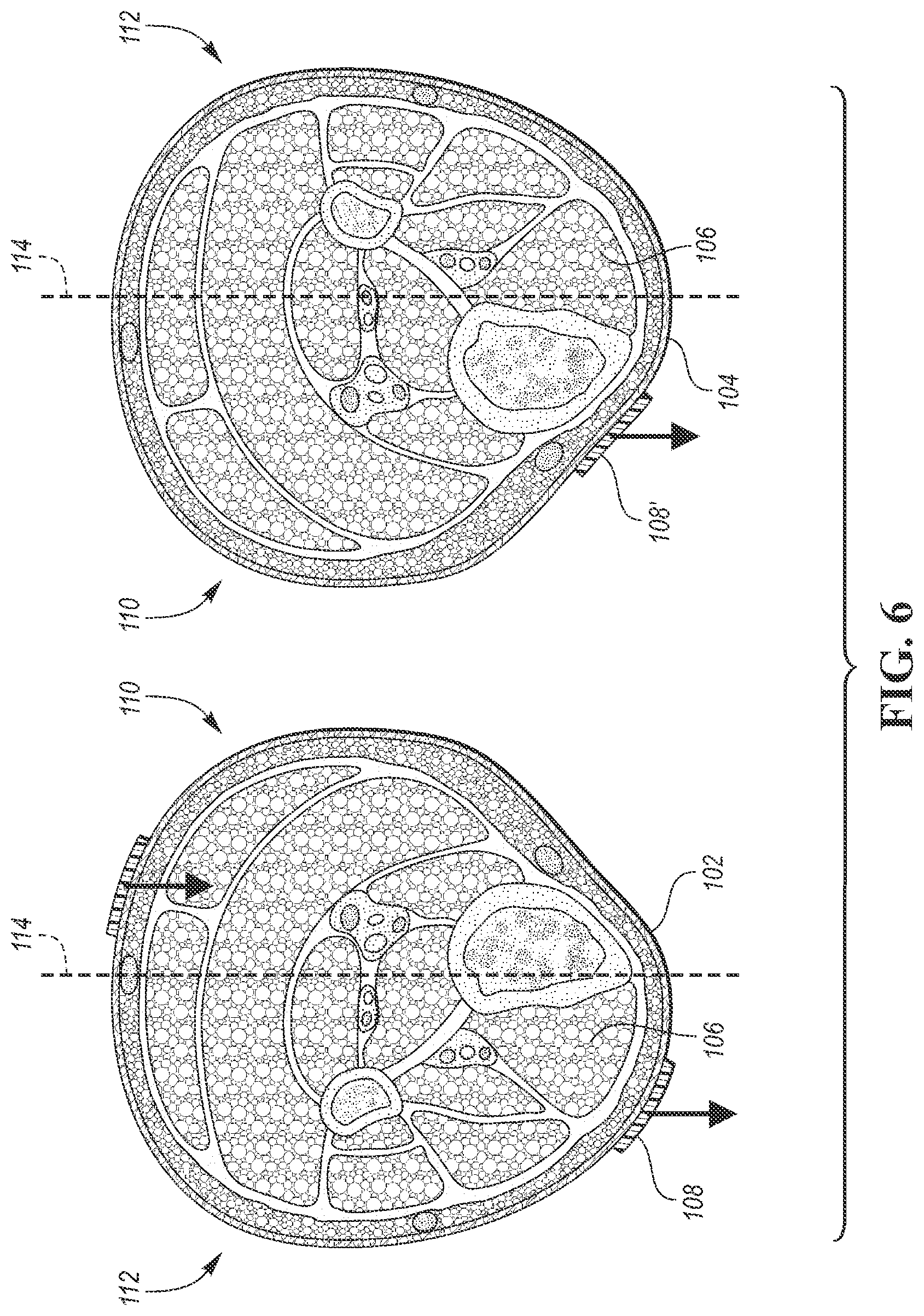 Patent US12090320 Figure 6 – Neuromuscular sensing device with multi-sensor array