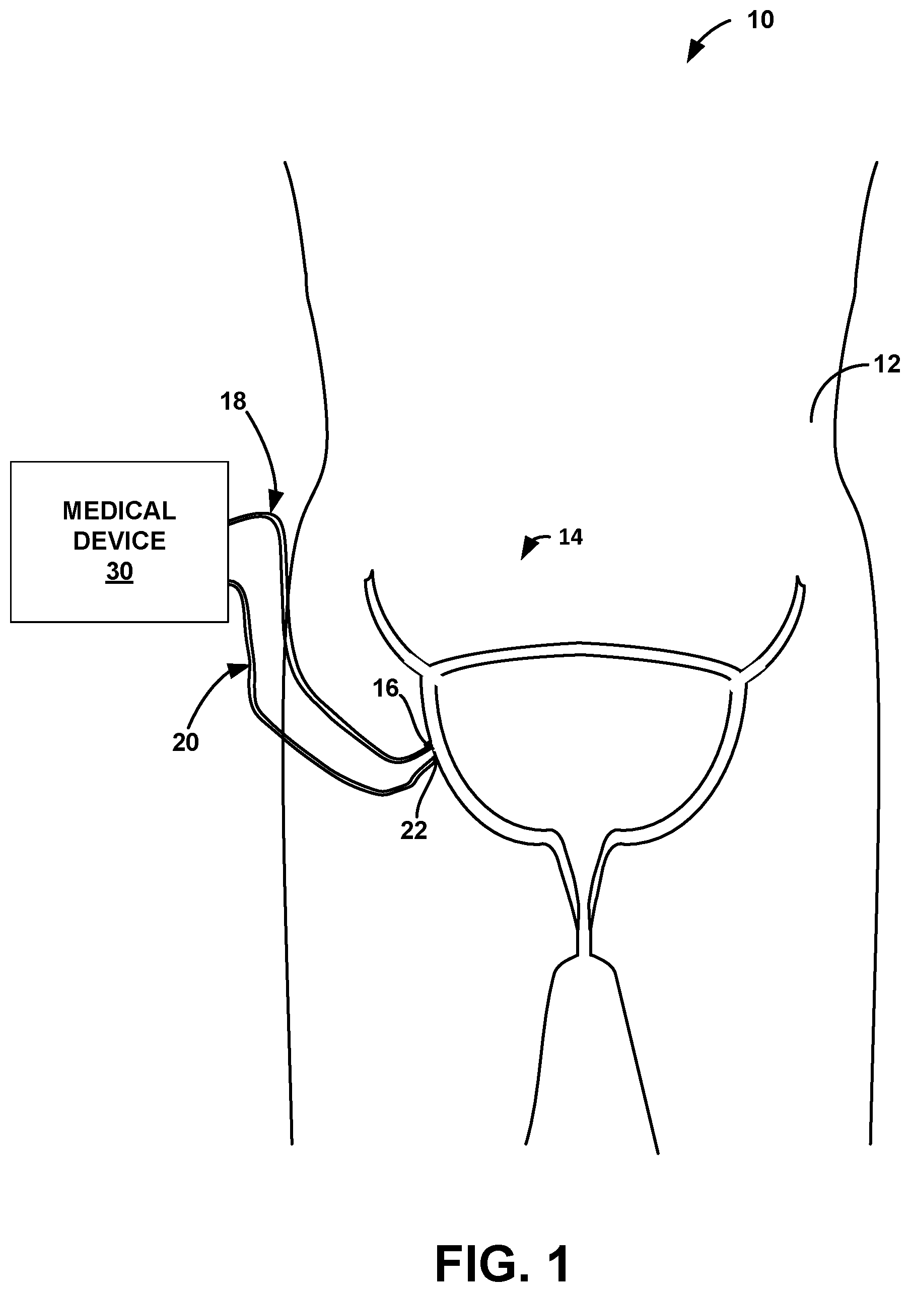 Patent US12090321 Figure 1 – Lead placement for nerve stimulation