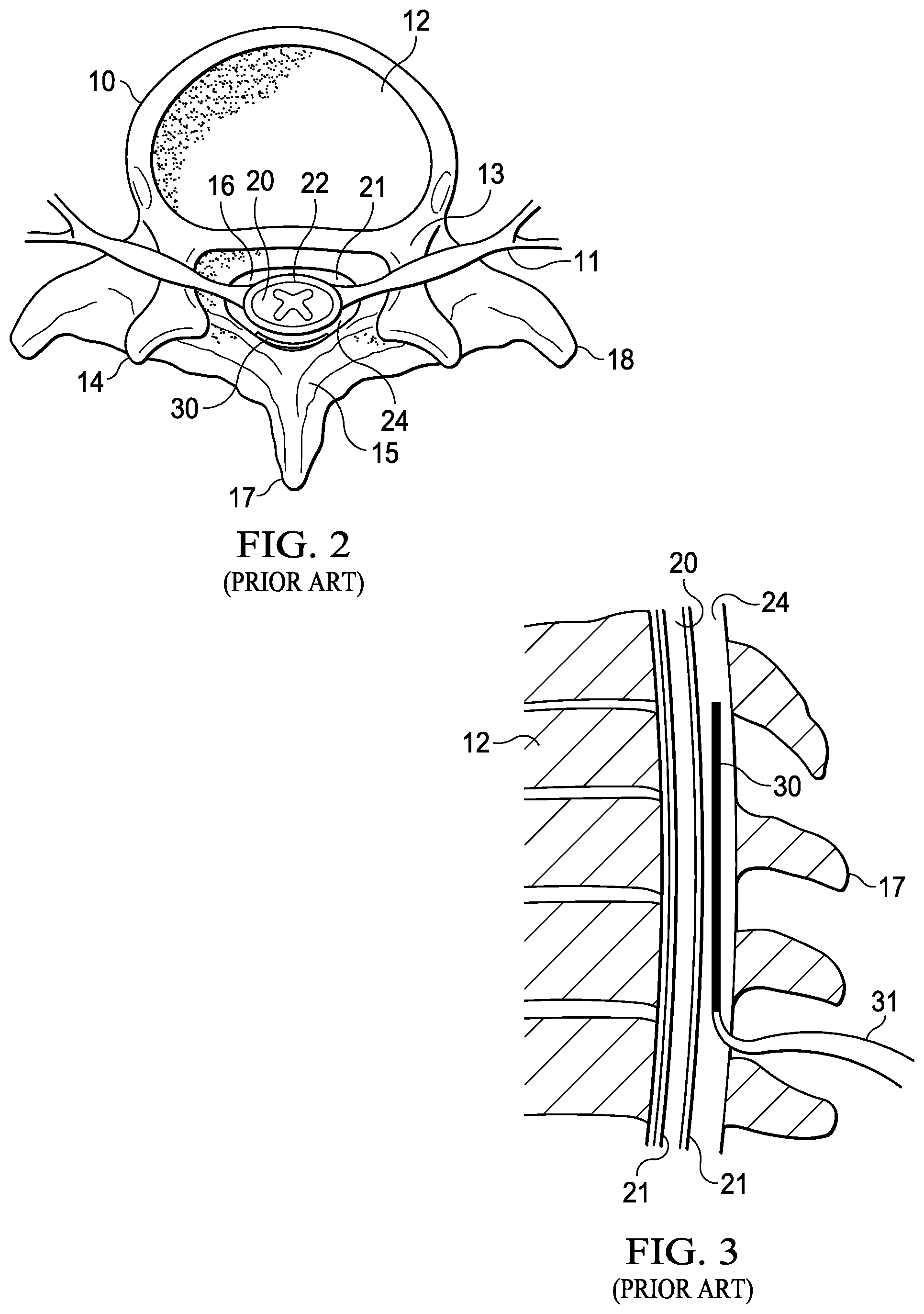 Patent US12090322 Figure 2 – Randomized intermittent stimulation paradigm and method of use