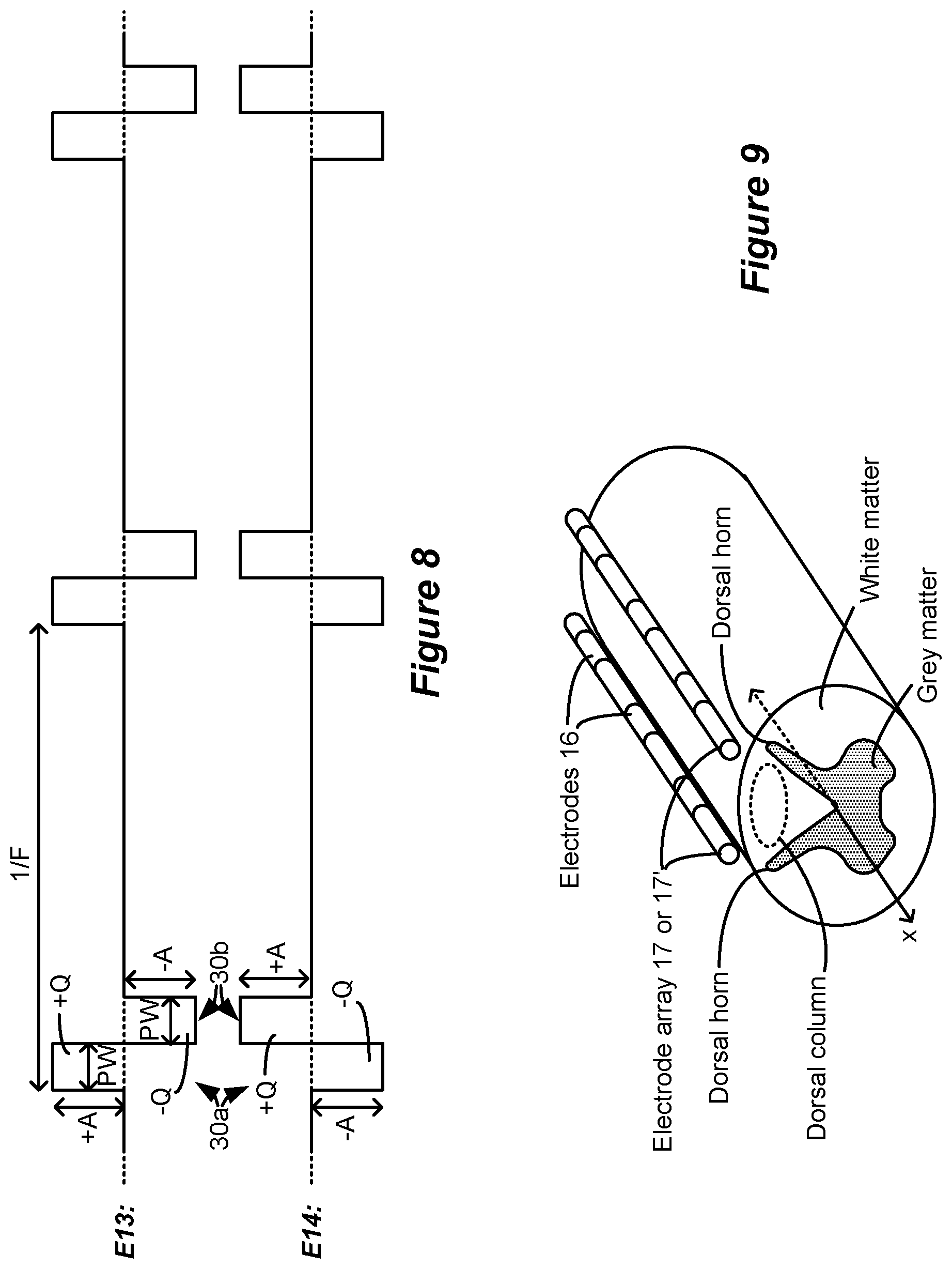 Patent US12090324 Figure 6 – Spinal cord stimulation for dorsal column recruitment or suppression using anodic and cathodic pulses