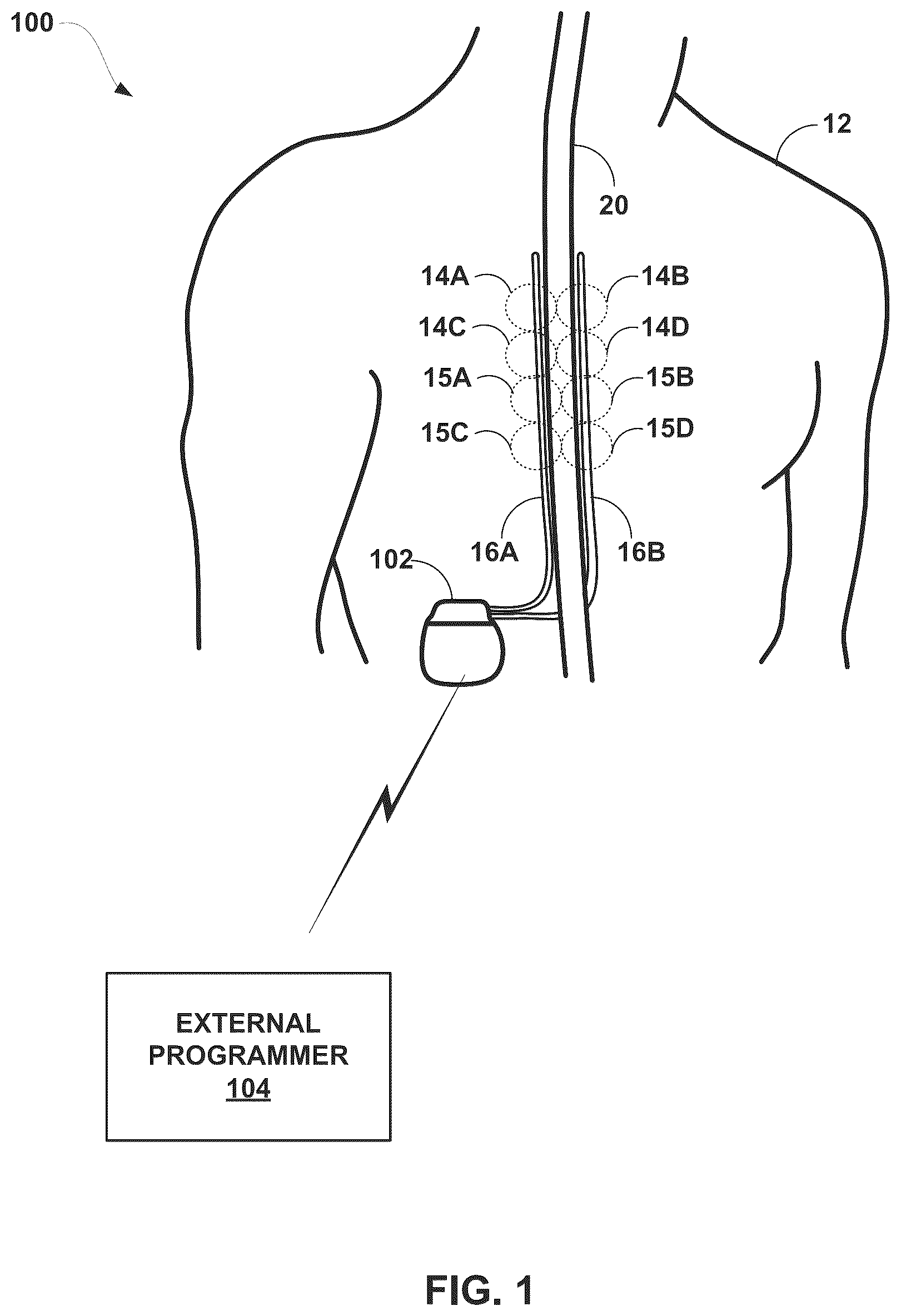 Patent US12090325 Figure 1 – Management of electrical stimulation therapy