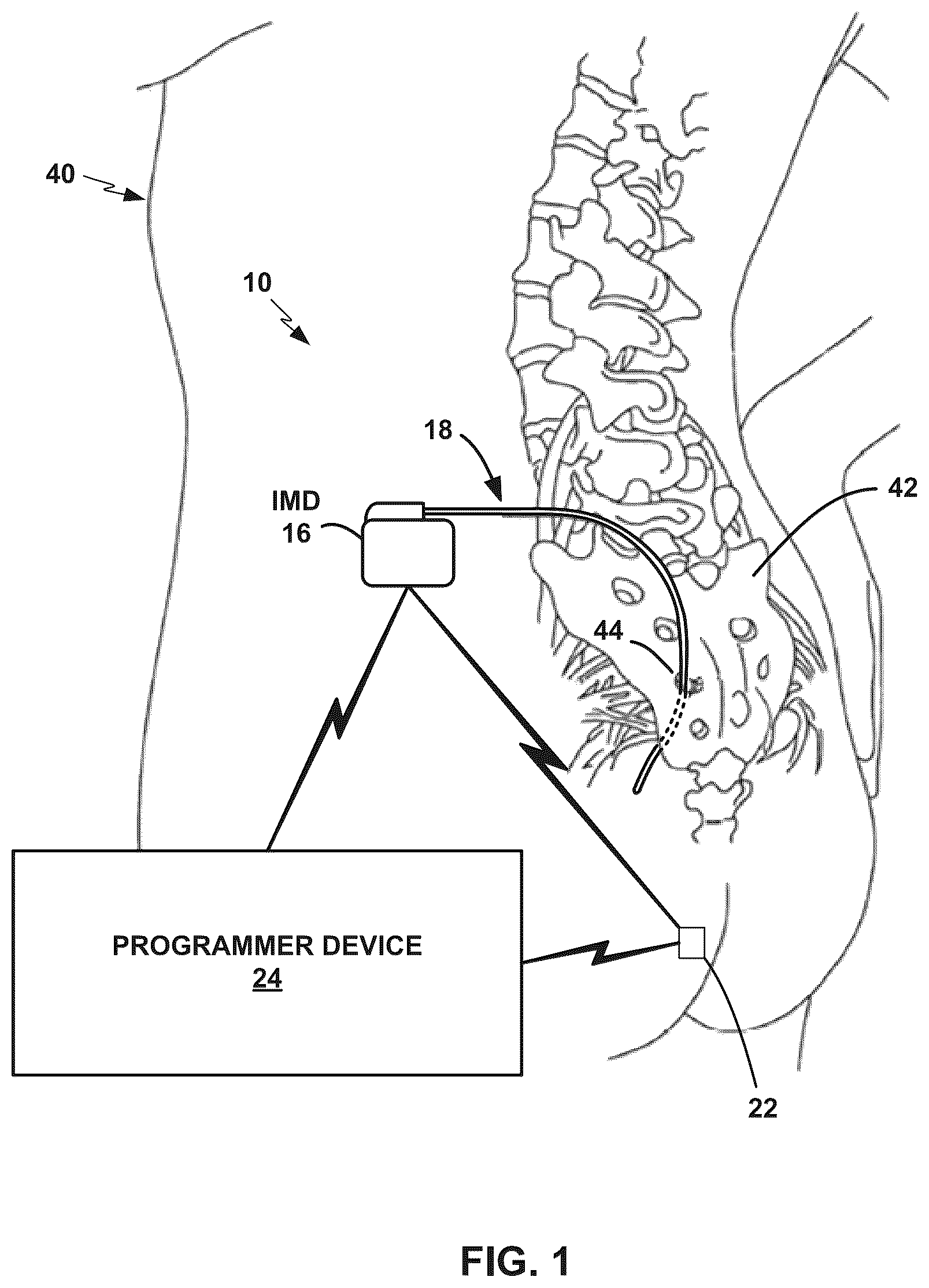 Patent US12090326 Figure 1 – Stimulation vector selection using pulse width data
