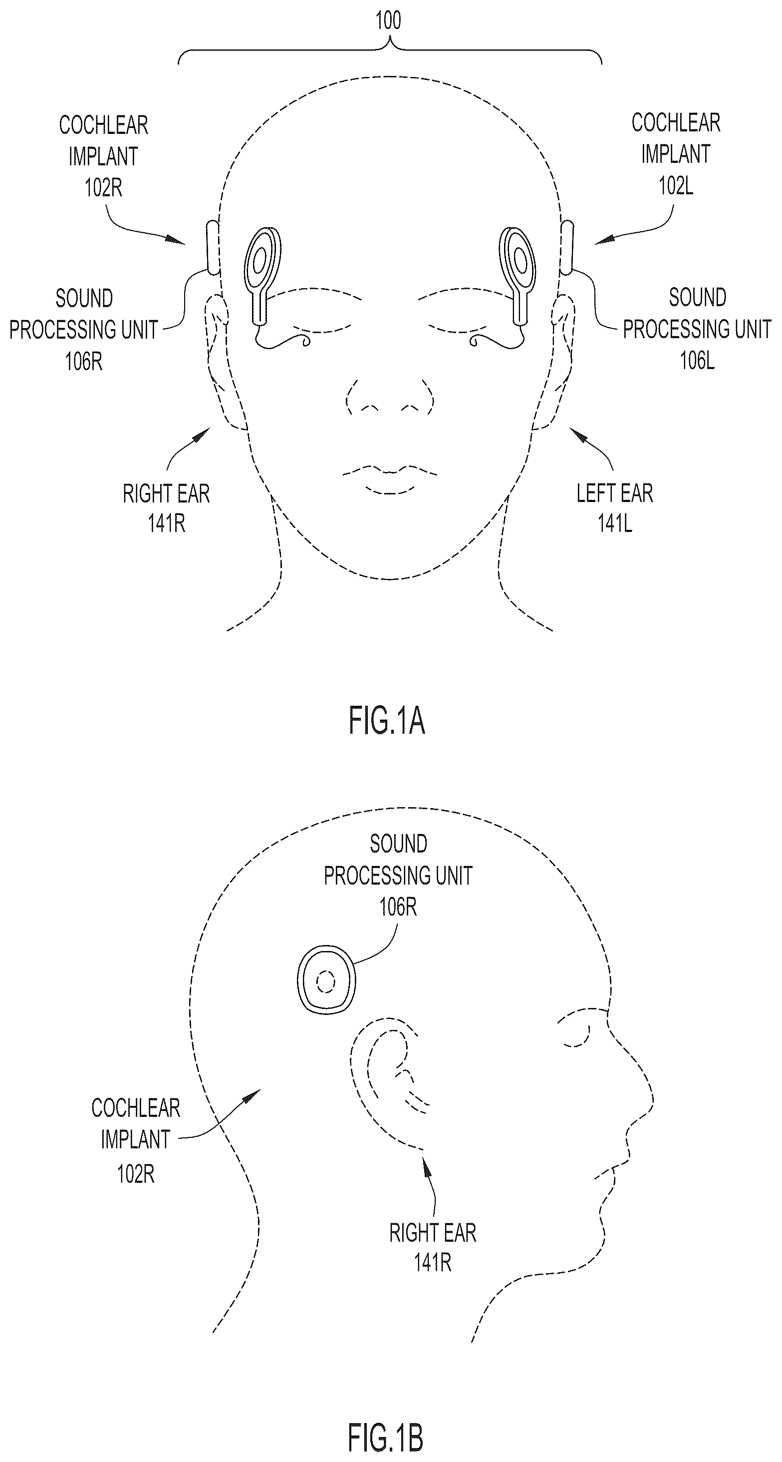 Patent US12090327 Figure 1 – Synchronized pitch and timing cues in a hearing prosthesis system