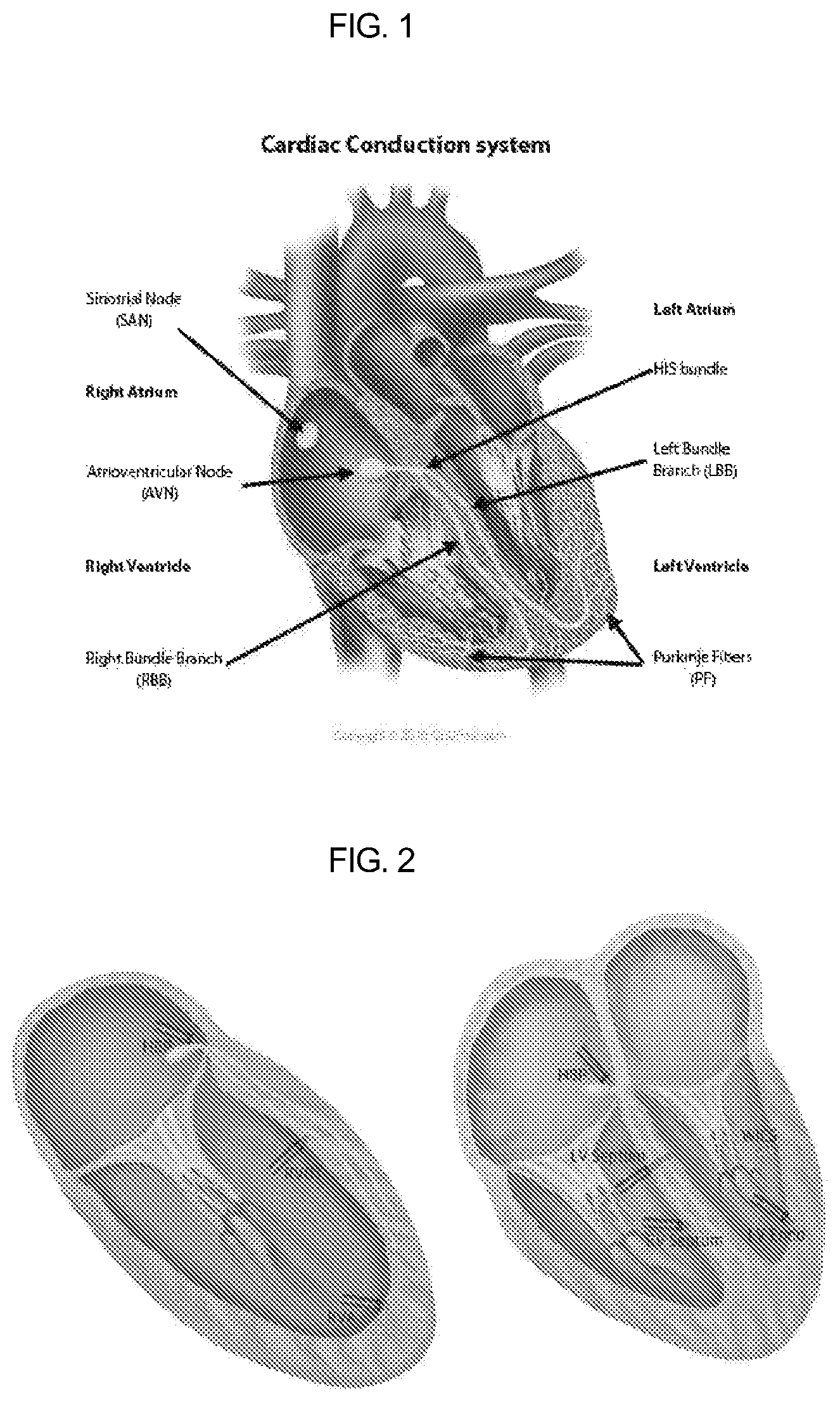 Patent US12090329 Figure 1 – Pacemaker lead for cerclage pacing