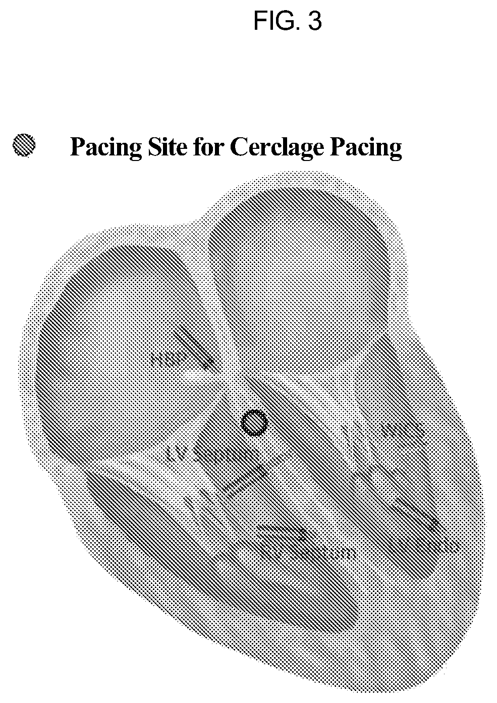 Patent US12090329 Figure 2 – Pacemaker lead for cerclage pacing