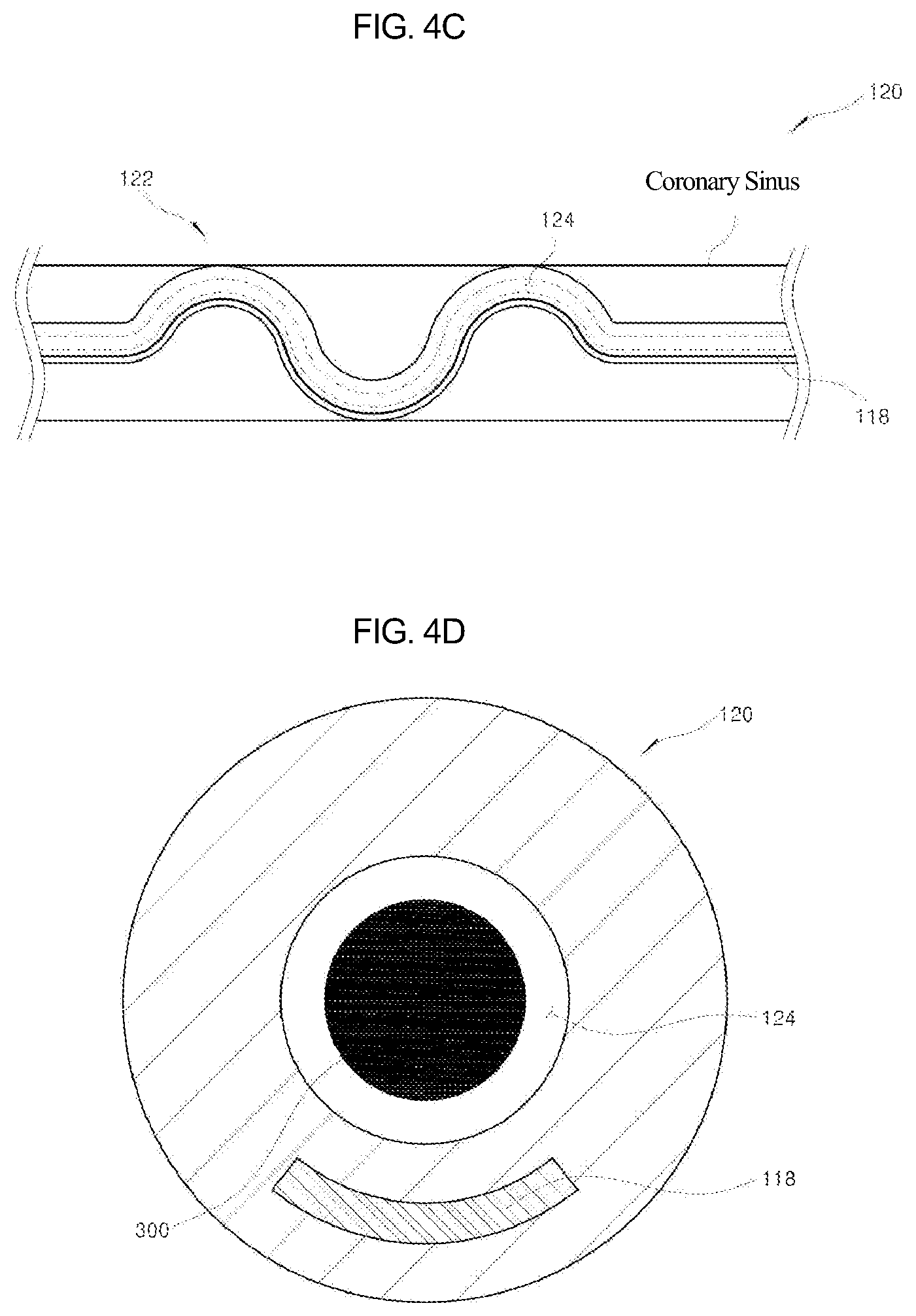 Patent US12090329 Figure 5 – Pacemaker lead for cerclage pacing
