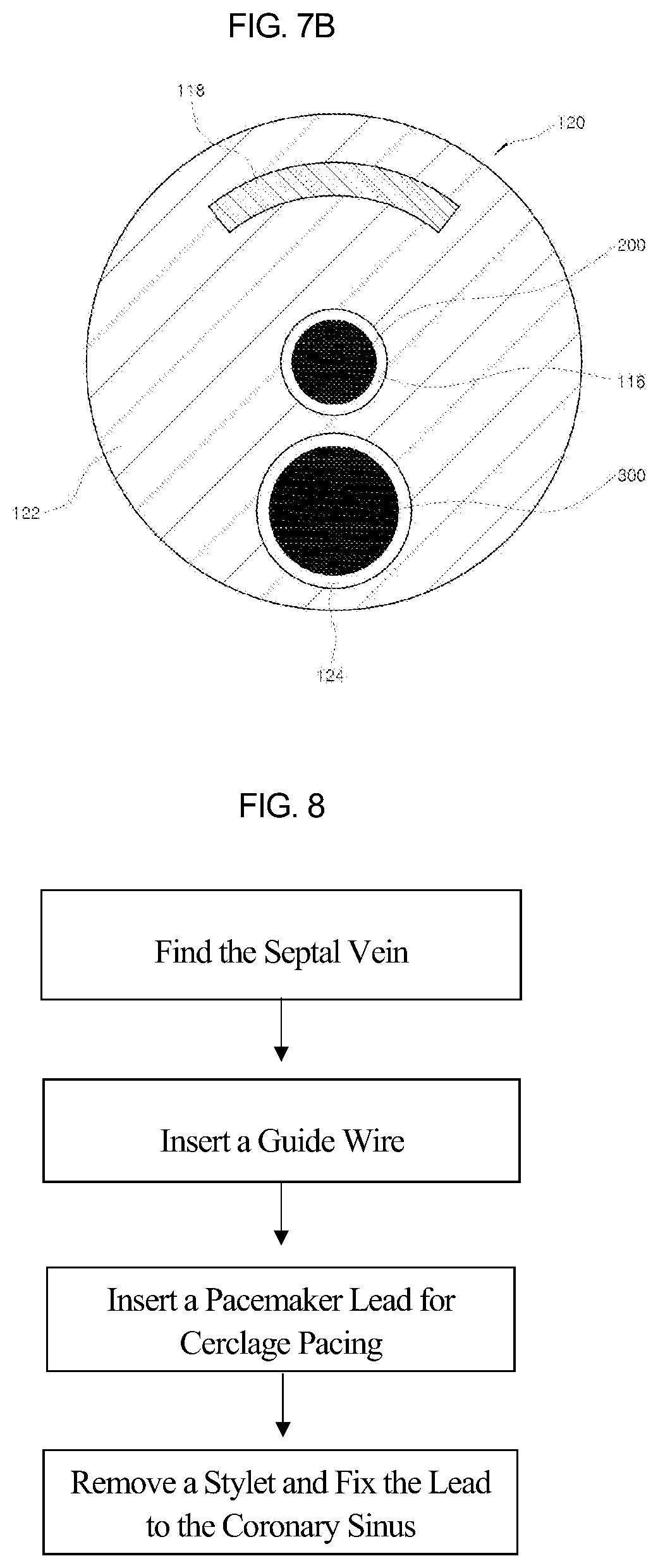 Patent US12090329 Figure 9 – Pacemaker lead for cerclage pacing