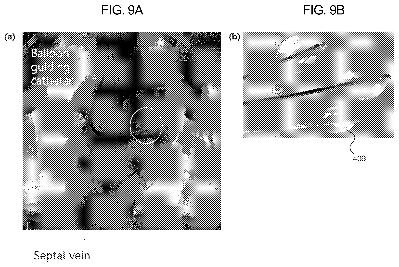 Patent US12090329 Figure 10 – Pacemaker lead for cerclage pacing