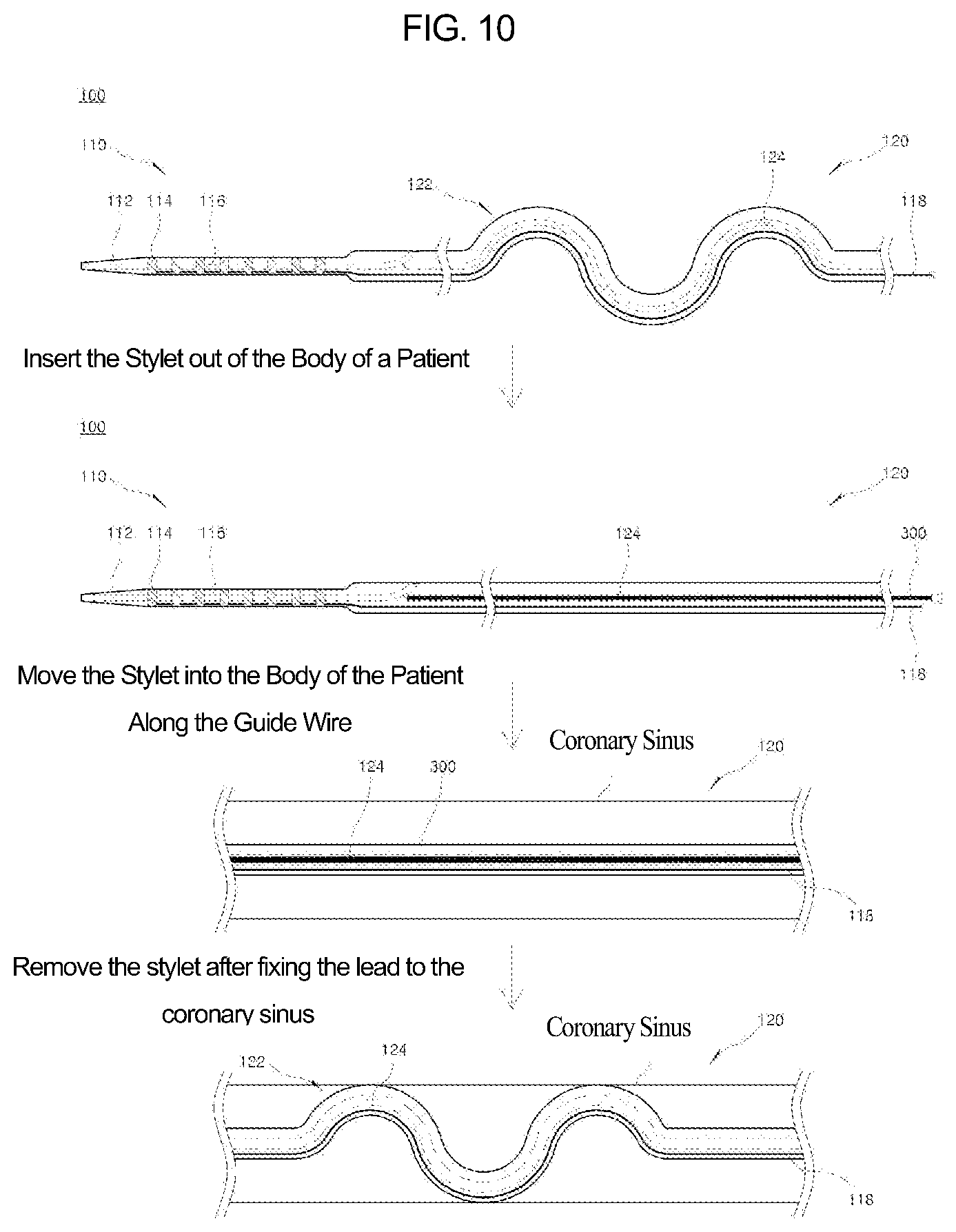 Patent US12090329 Figure 11 – Pacemaker lead for cerclage pacing