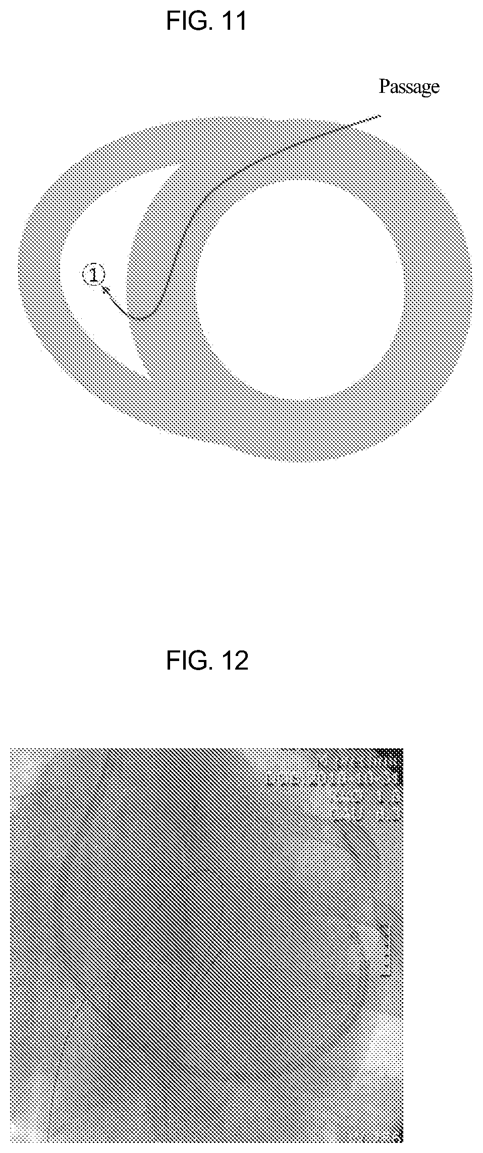 Patent US12090329 Figure 12 – Pacemaker lead for cerclage pacing