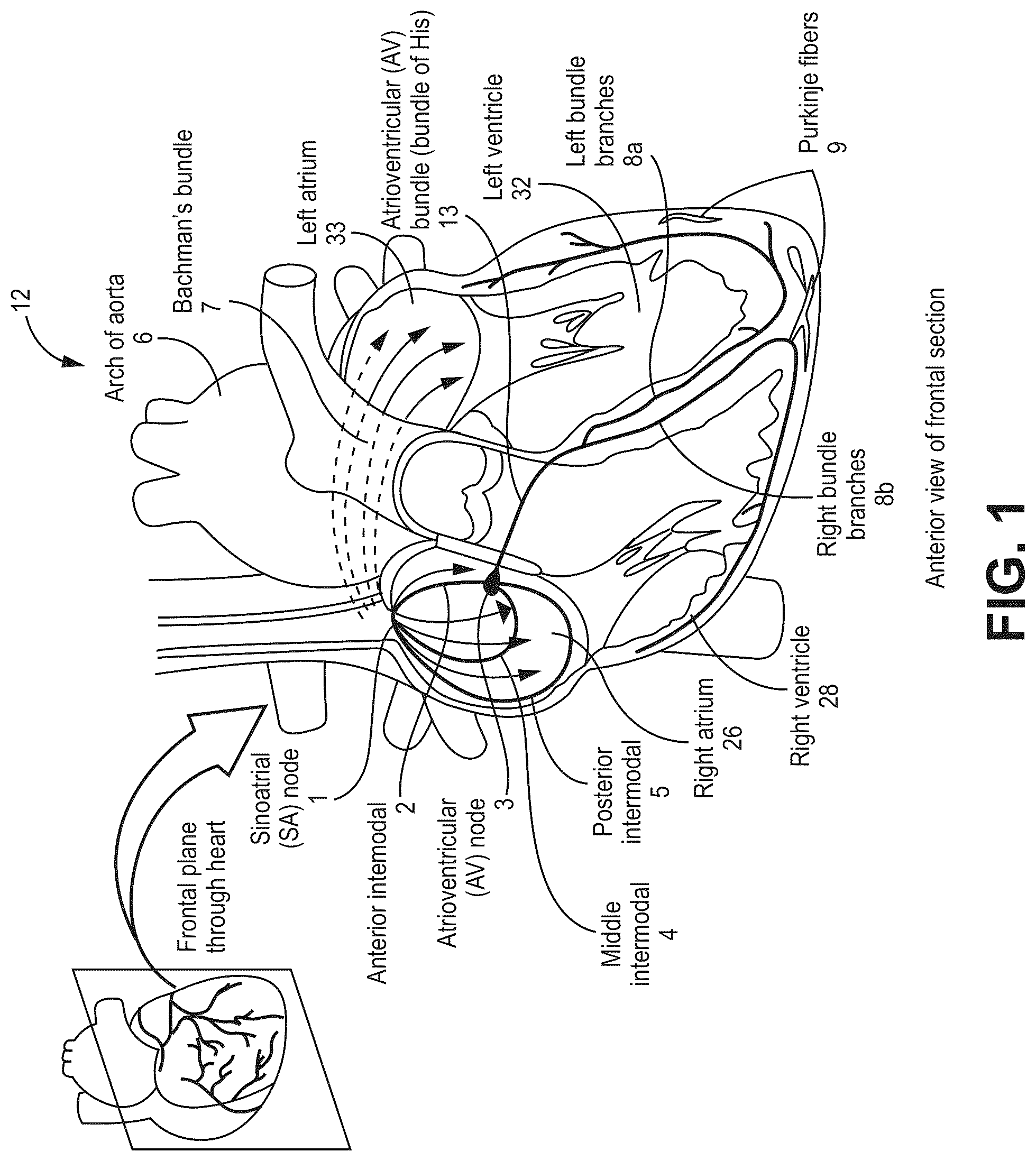 Patent US12090330 Figure 1 – Bundle branch pacing devices and methods