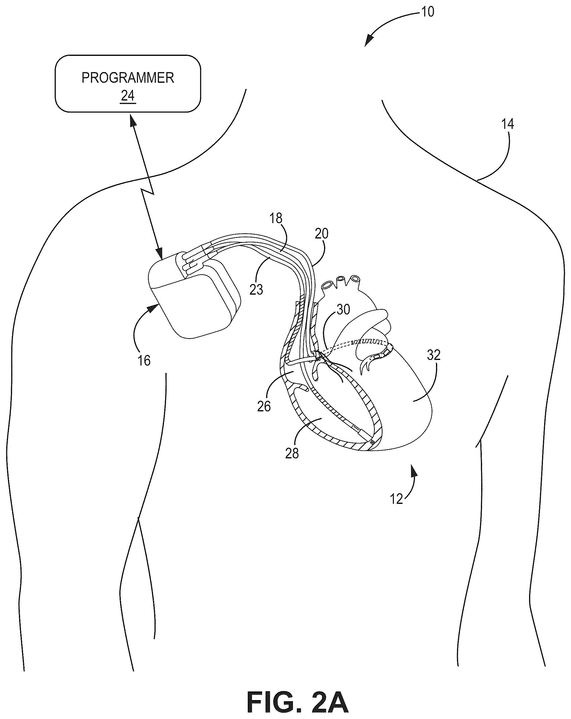 Patent US12090330 Figure 2 – Bundle branch pacing devices and methods