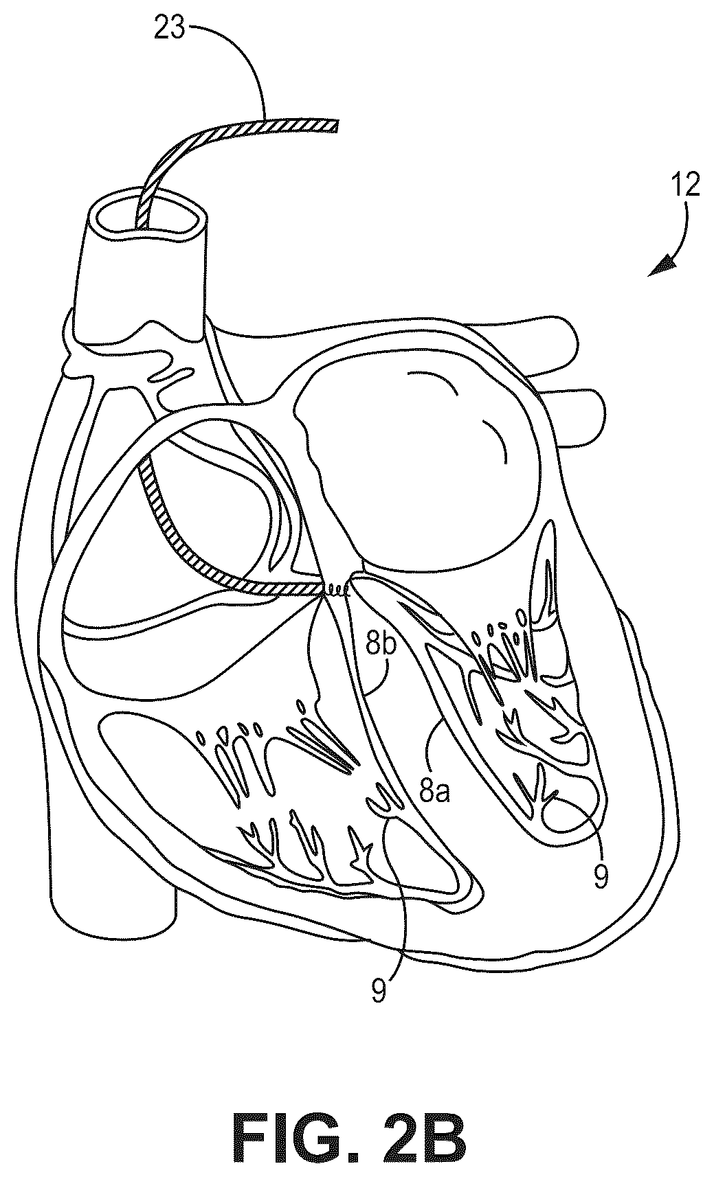 Patent US12090330 Figure 3 – Bundle branch pacing devices and methods