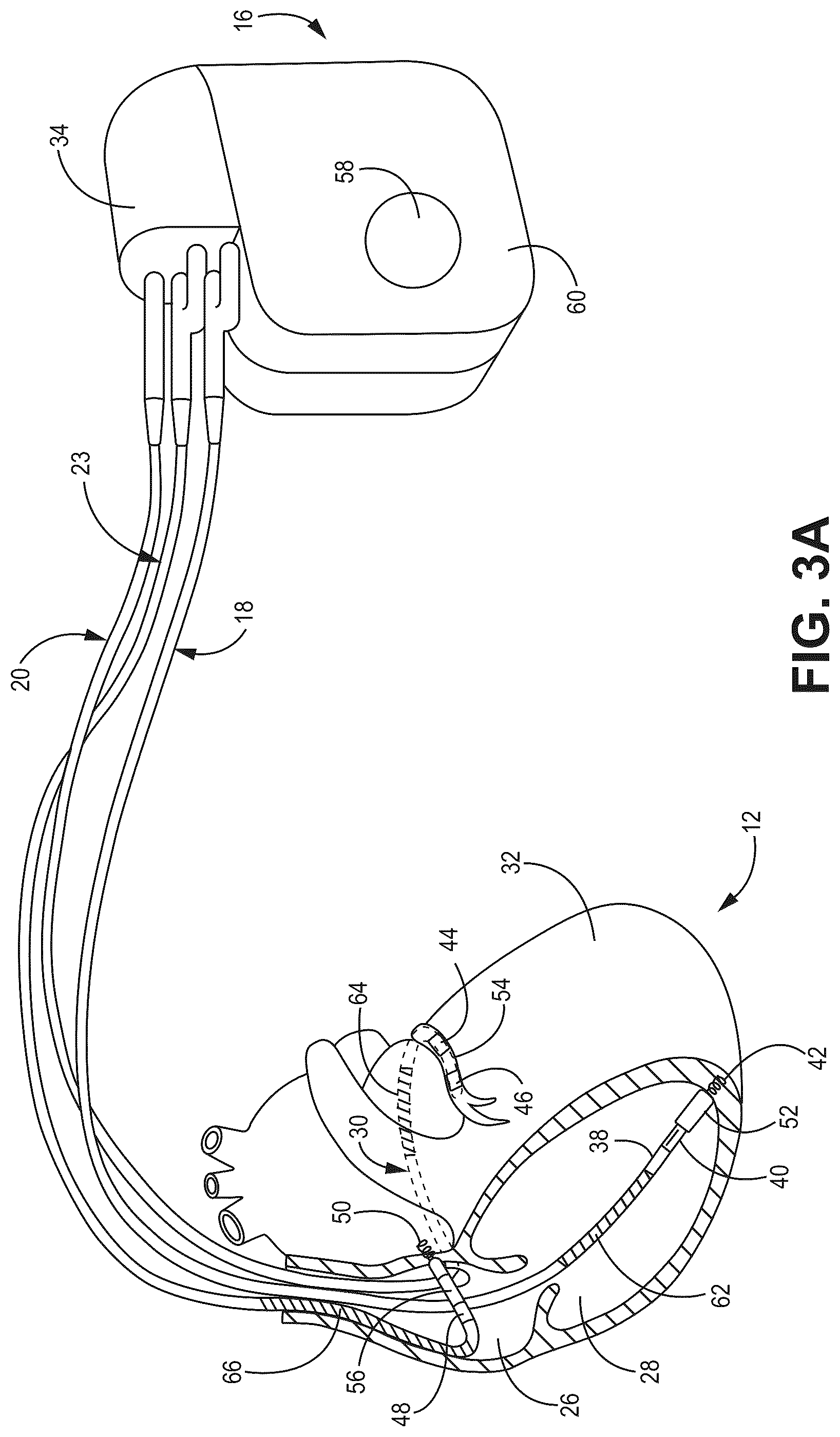 Patent US12090330 Figure 4 – Bundle branch pacing devices and methods