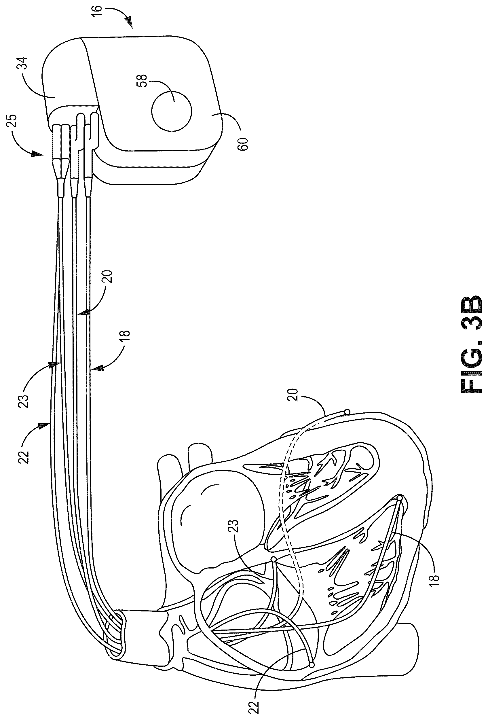 Patent US12090330 Figure 5 – Bundle branch pacing devices and methods