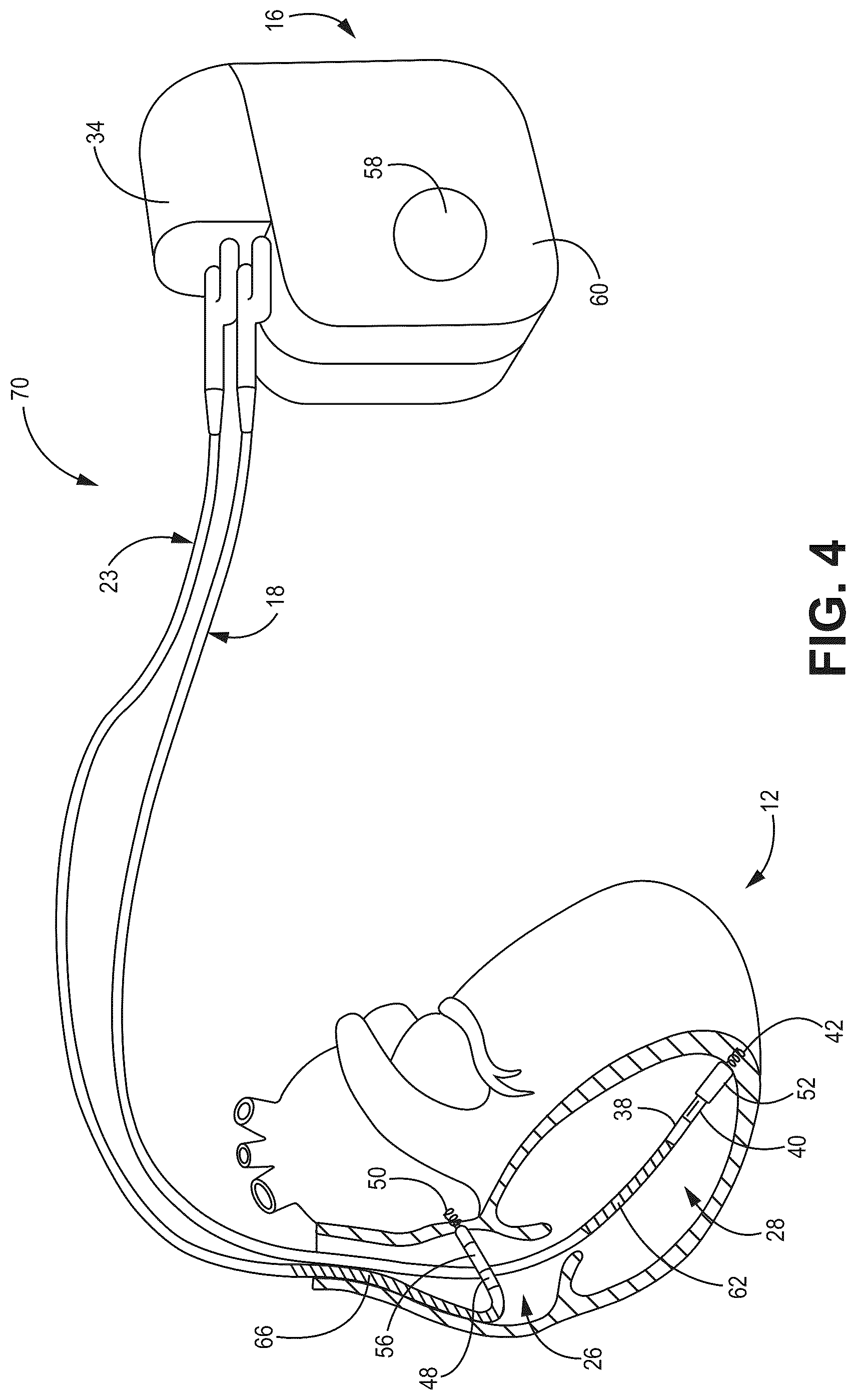 Patent US12090330 Figure 6 – Bundle branch pacing devices and methods