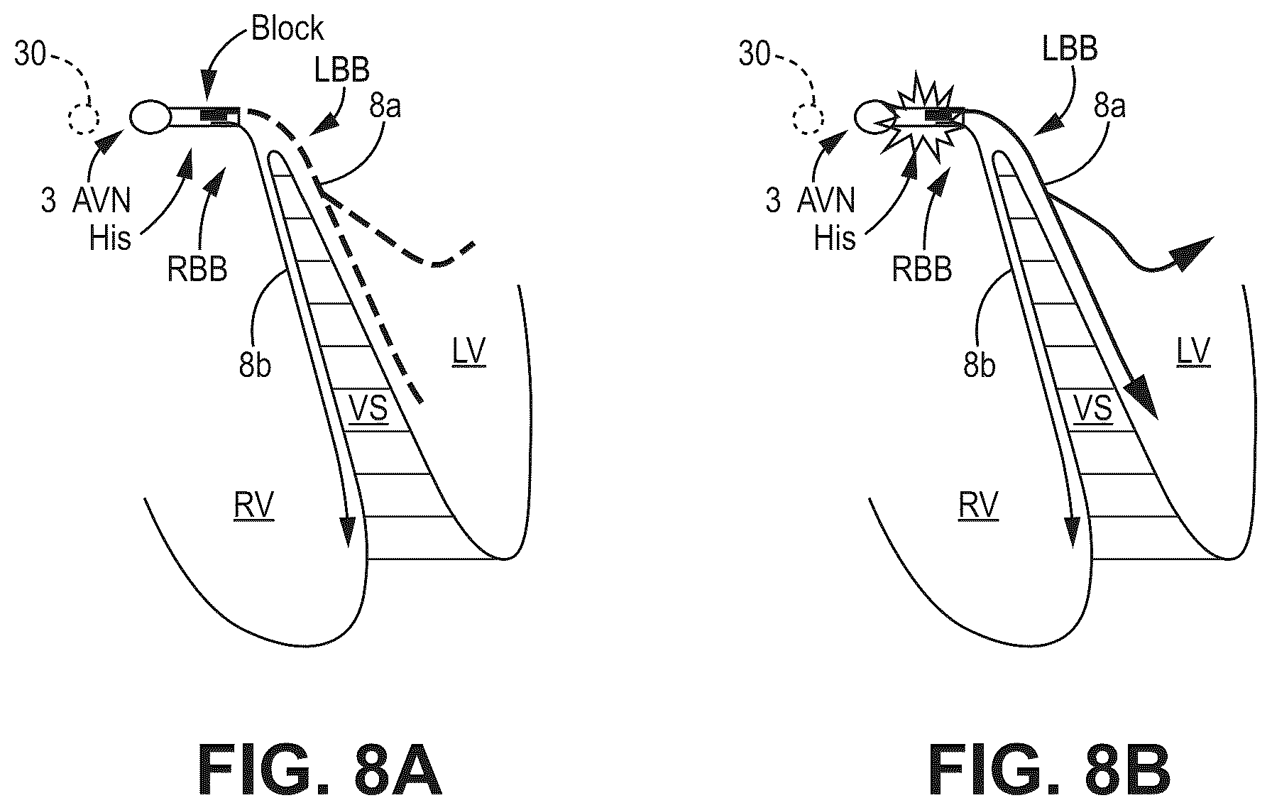 Patent US12090330 Figure 10 – Bundle branch pacing devices and methods