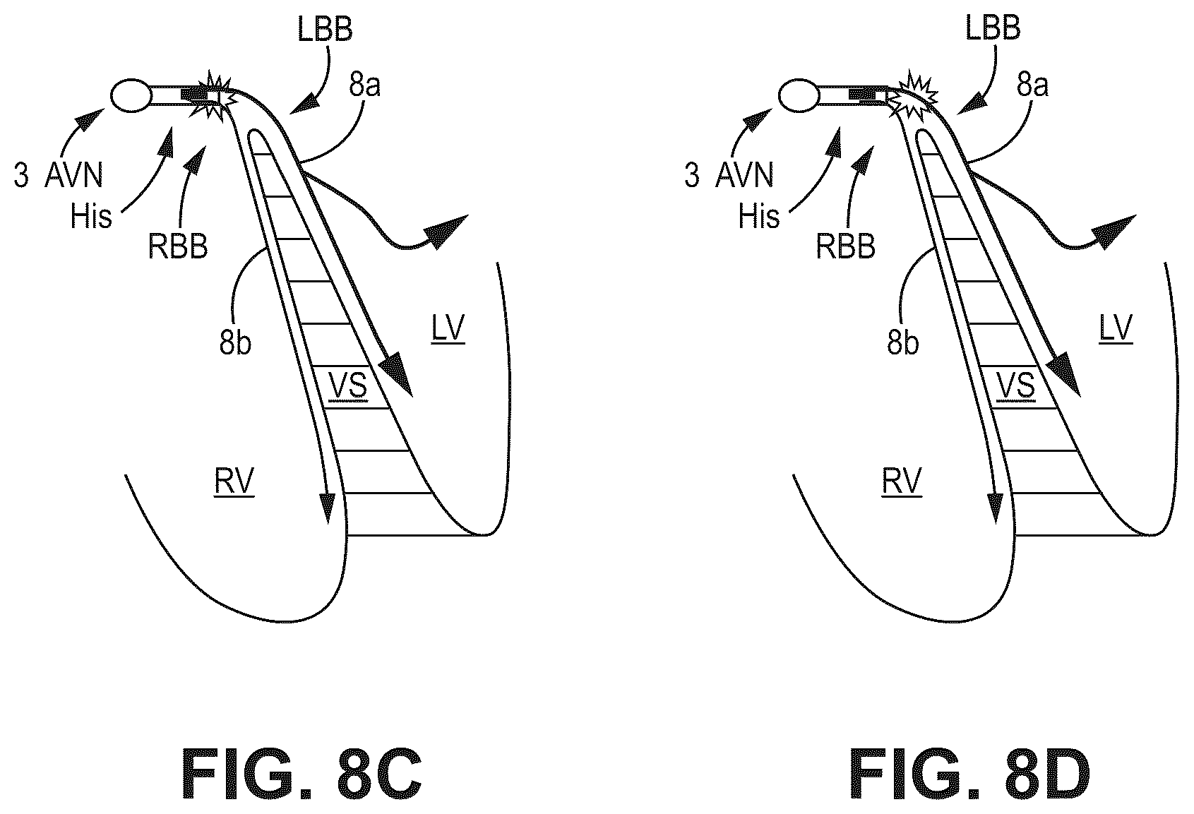 Patent US12090330 Figure 11 – Bundle branch pacing devices and methods