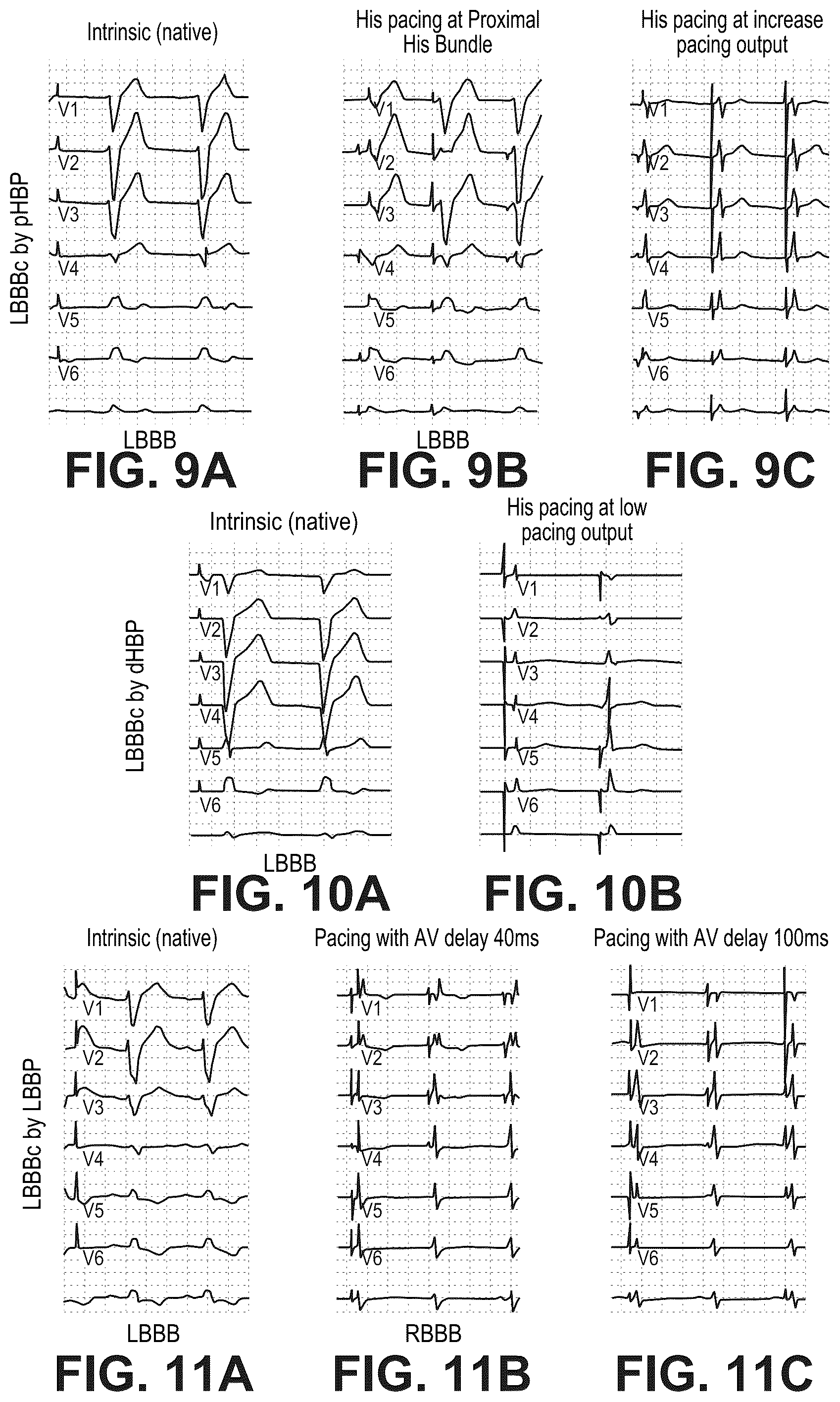 Patent US12090330 Figure 12 – Bundle branch pacing devices and methods