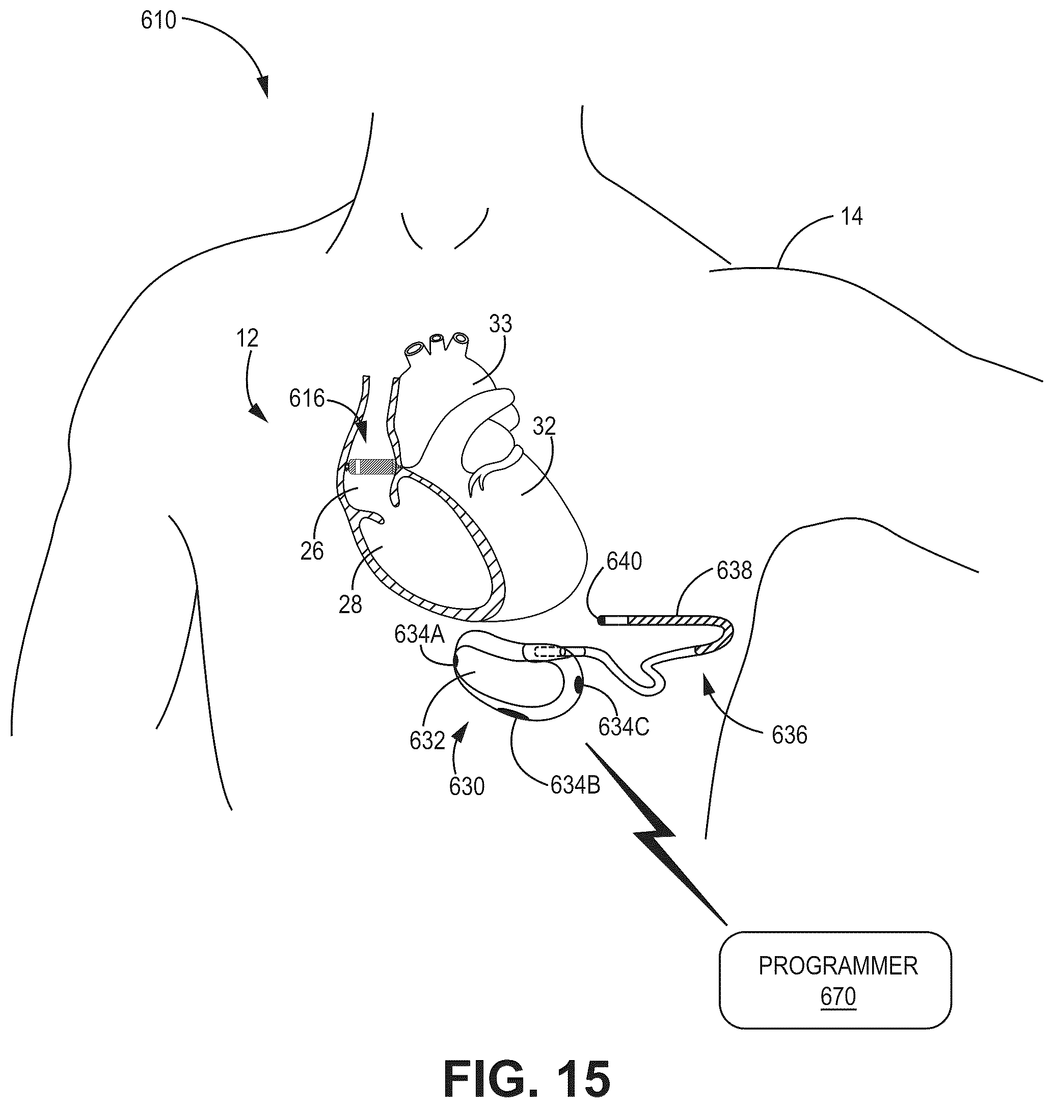 Patent US12090330 Figure 16 – Bundle branch pacing devices and methods