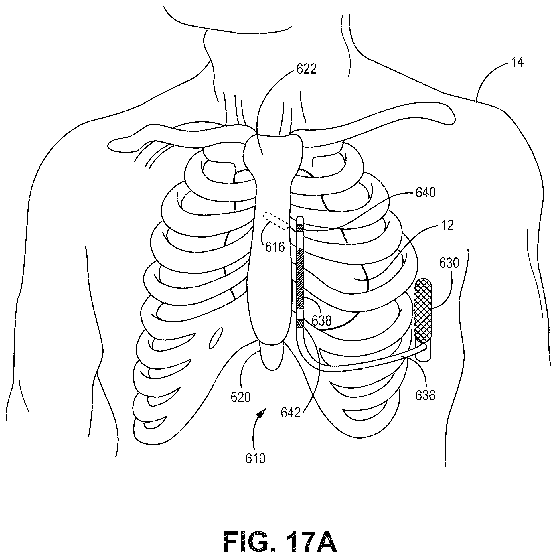 Patent US12090330 Figure 18 – Bundle branch pacing devices and methods