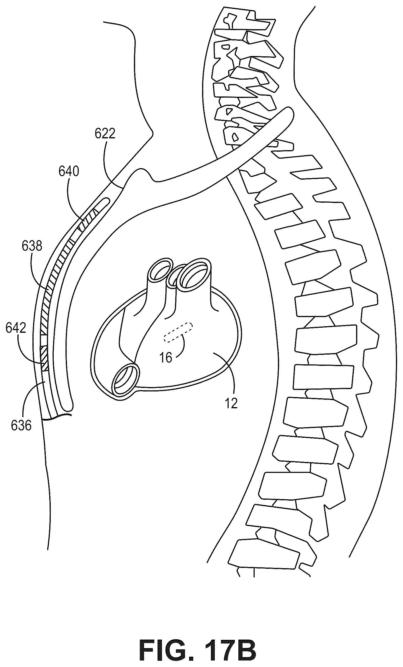 Patent US12090330 Figure 19 – Bundle branch pacing devices and methods