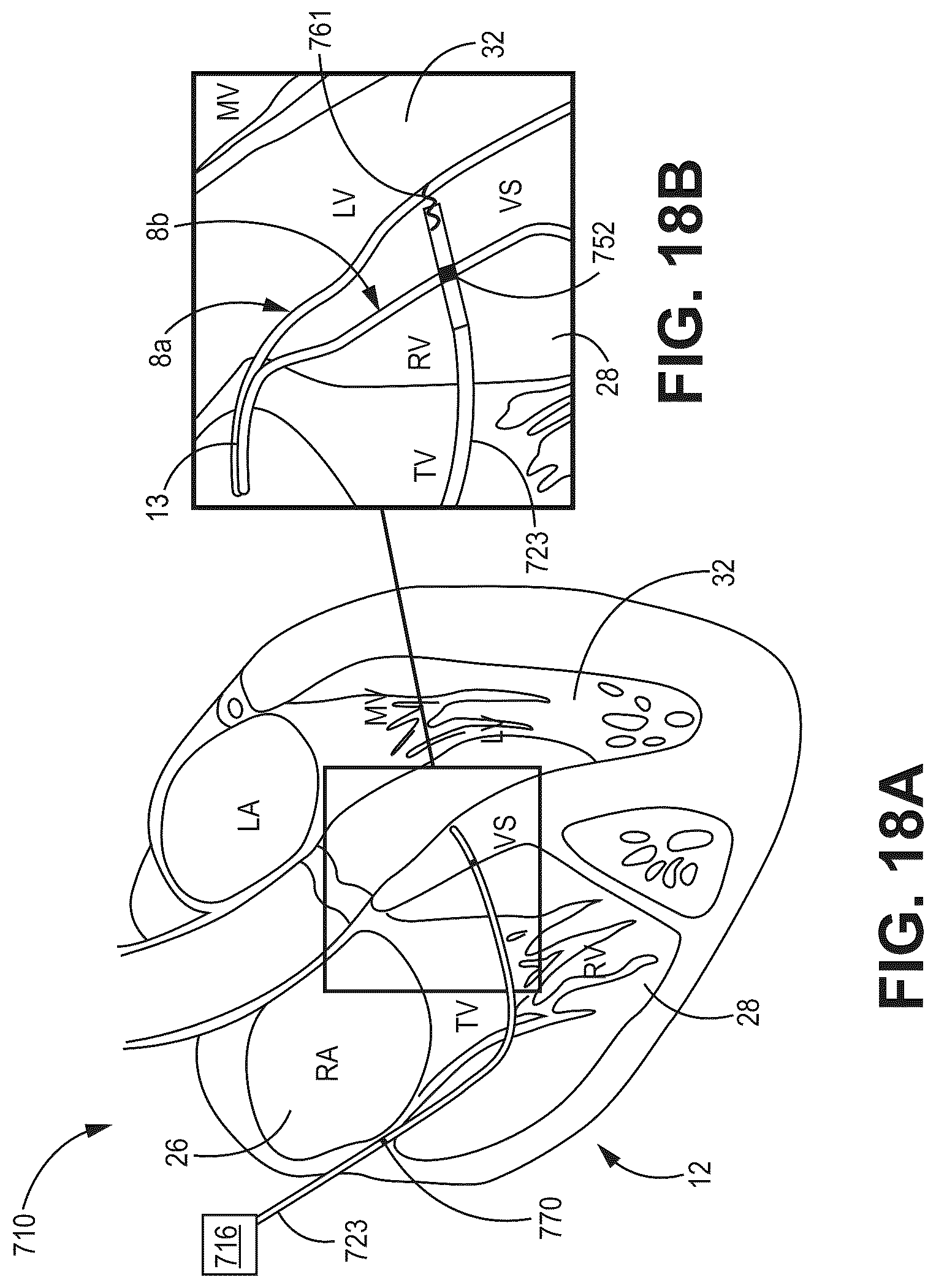 Patent US12090330 Figure 20 – Bundle branch pacing devices and methods