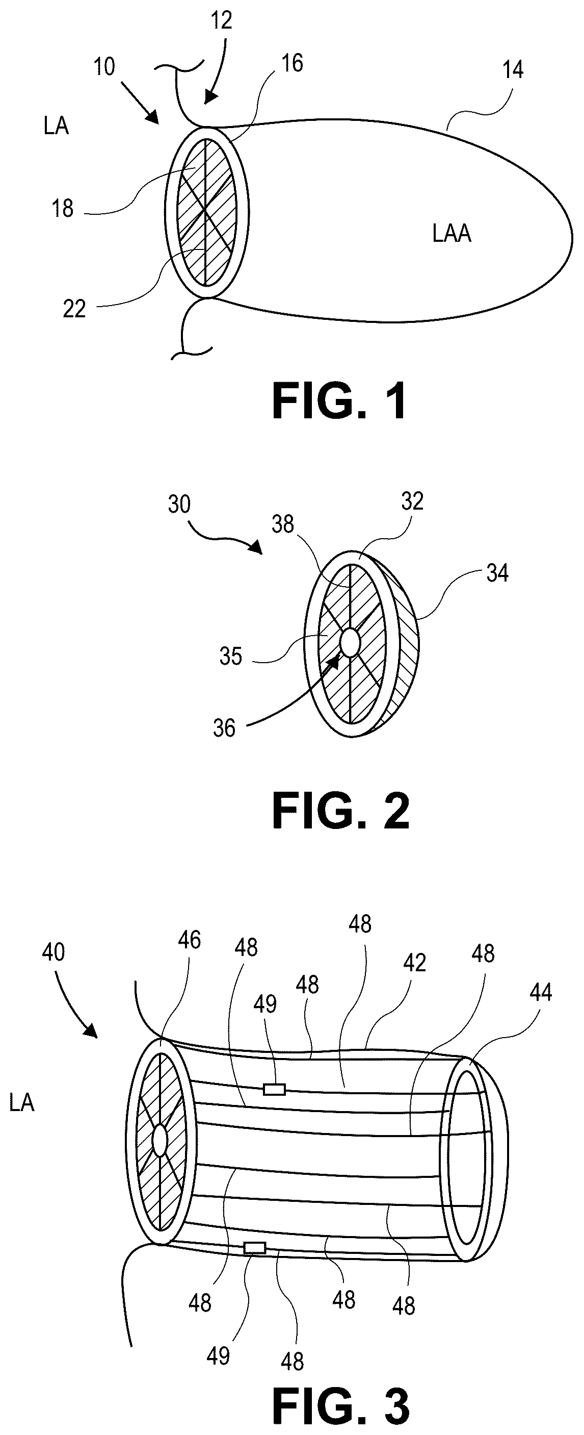 Patent US12090331 Figure 1 – Atrial appendage occlusion and arrhythmia treatment