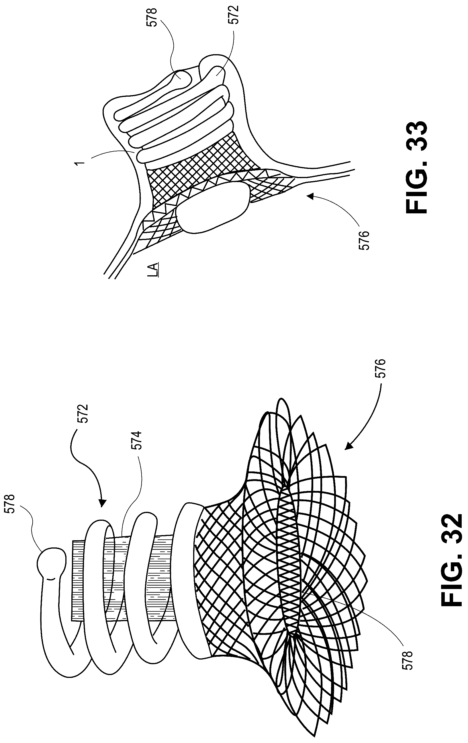 Patent US12090331 Figure 15 – Atrial appendage occlusion and arrhythmia treatment