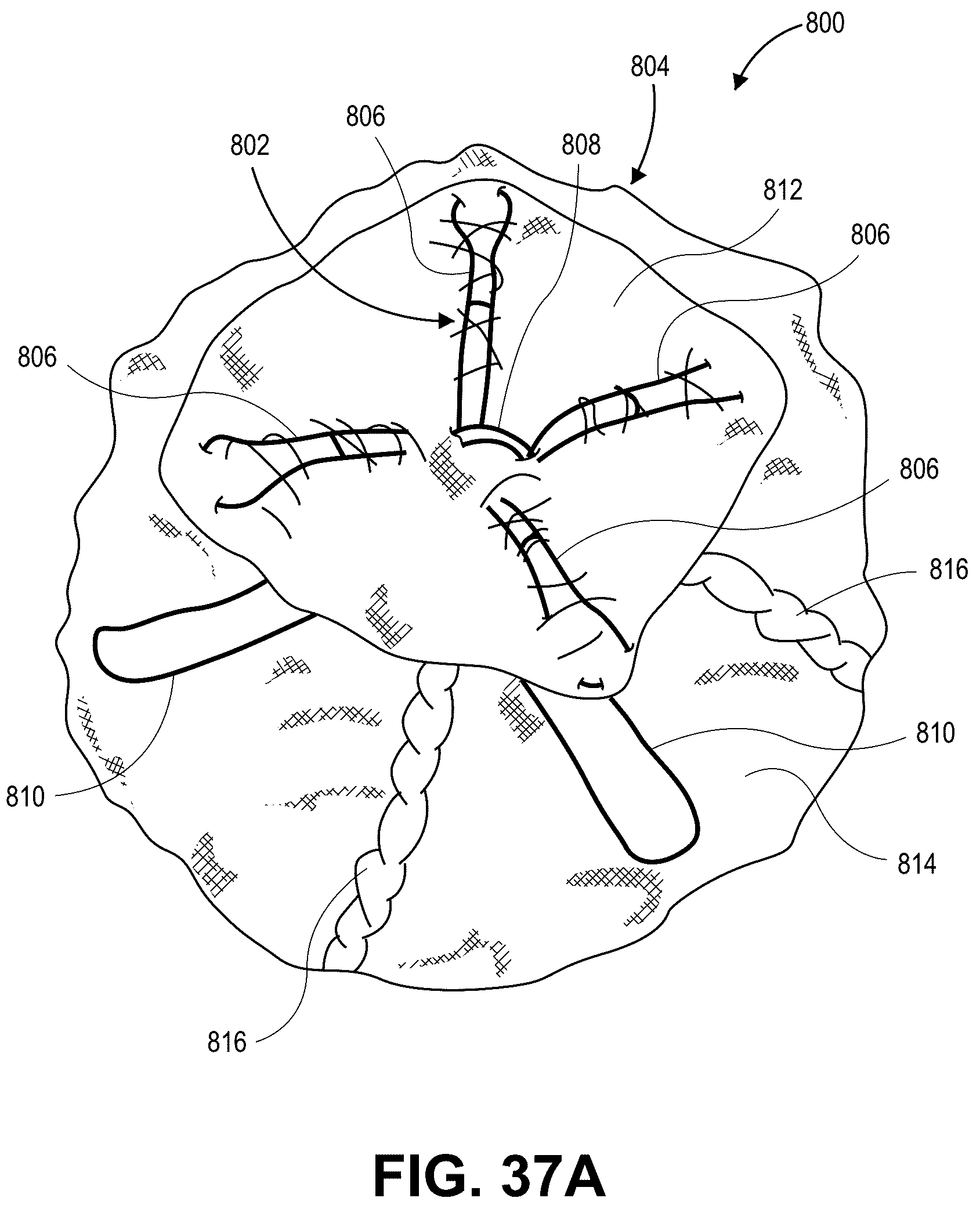 Patent US12090331 Figure 19 – Atrial appendage occlusion and arrhythmia treatment