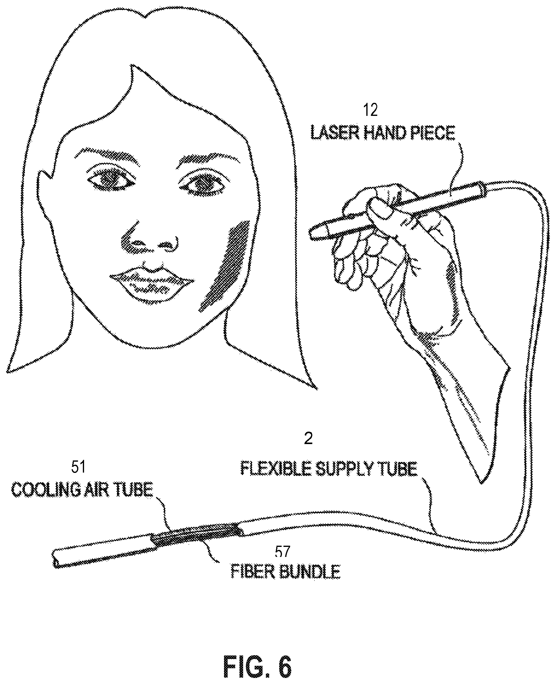 Patent US12090335 Figure 5 – Attachable tip for electromagnetic hand piece