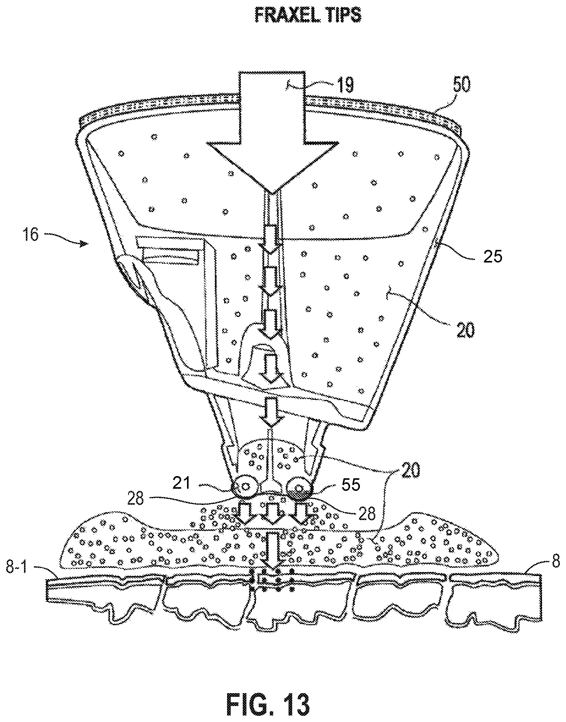 Patent US12090335 Figure 10 – Attachable tip for electromagnetic hand piece