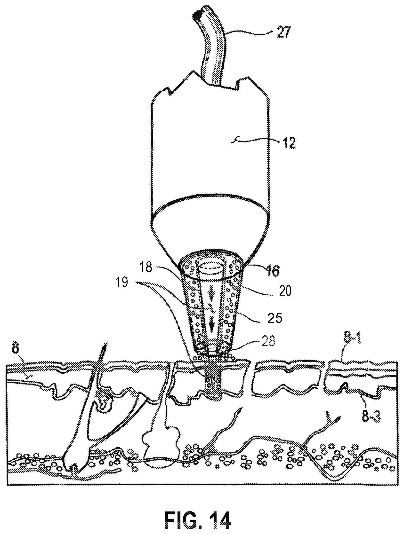Patent US12090335 Figure 11 – Attachable tip for electromagnetic hand piece