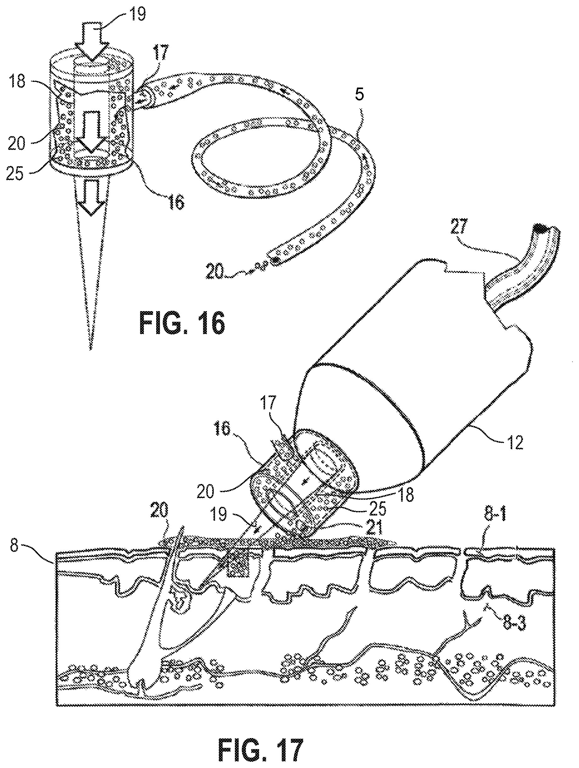 Patent US12090335 Figure 13 – Attachable tip for electromagnetic hand piece