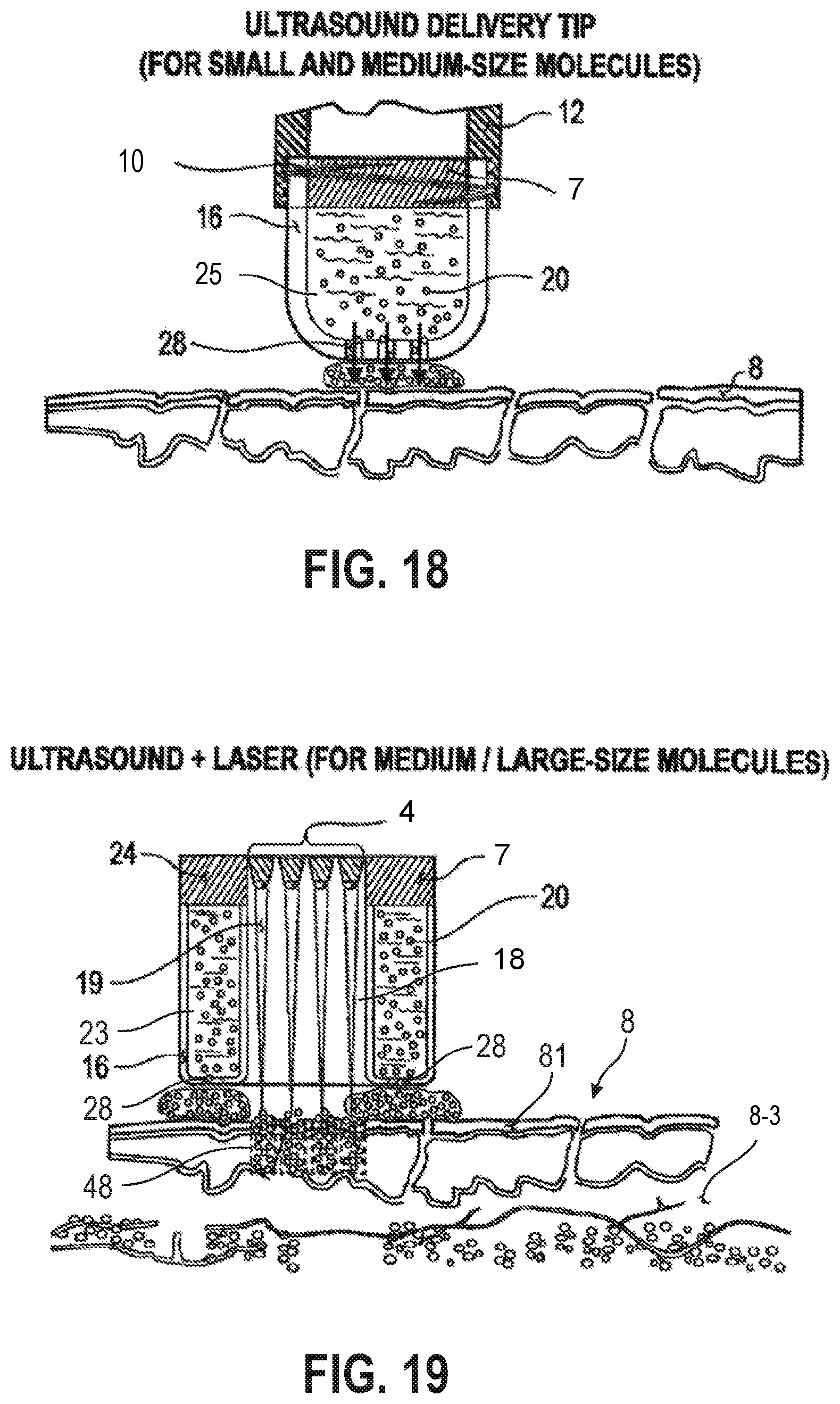 Patent US12090335 Figure 14 – Attachable tip for electromagnetic hand piece