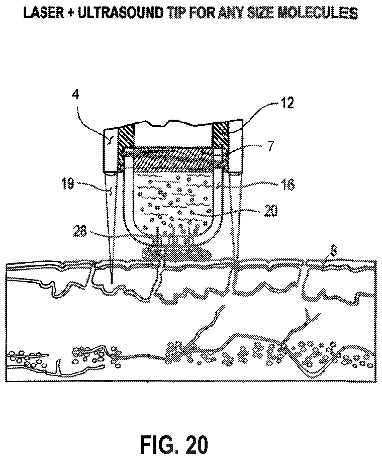 Patent US12090335 Figure 15 – Attachable tip for electromagnetic hand piece