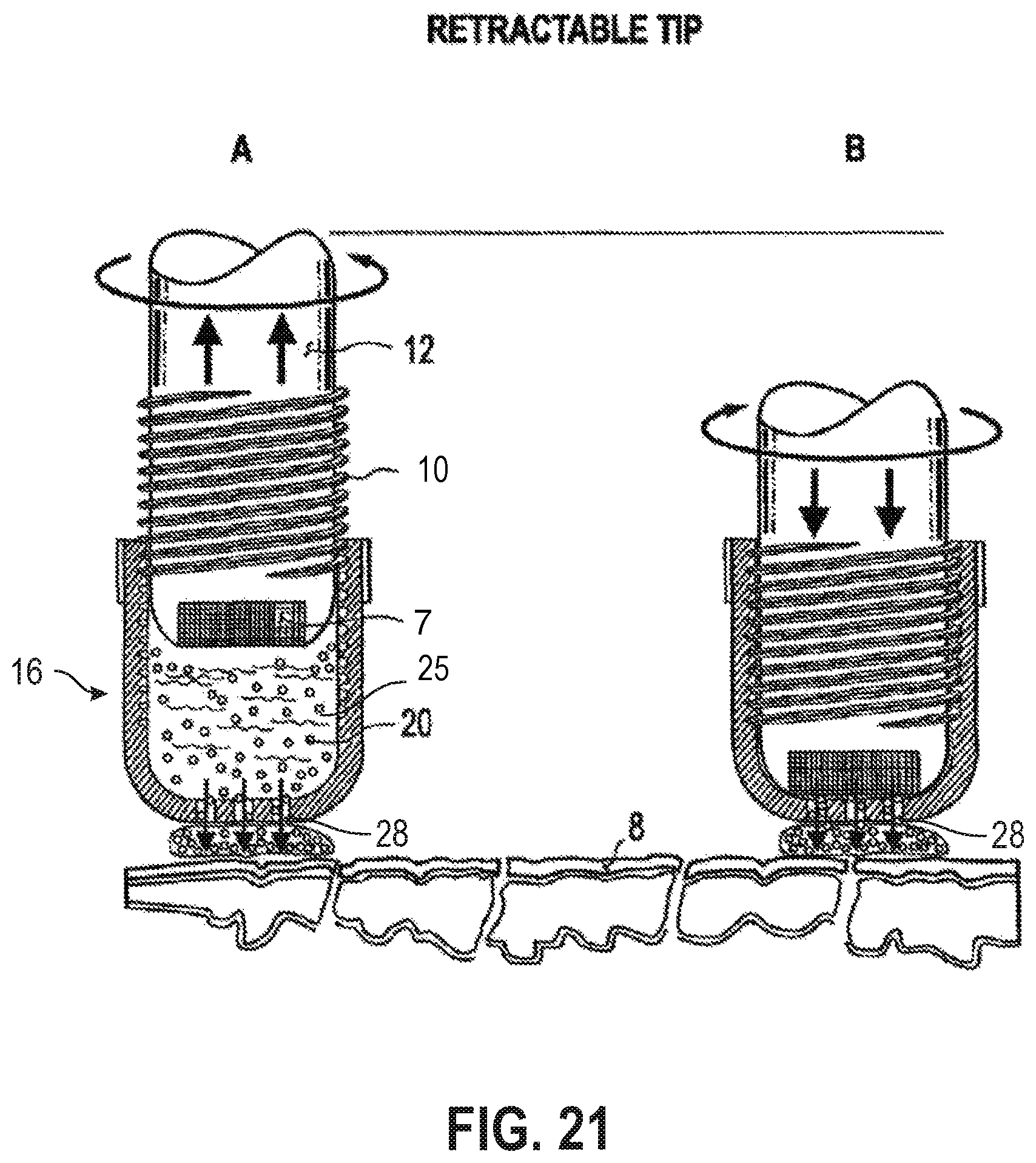 Patent US12090335 Figure 16 – Attachable tip for electromagnetic hand piece